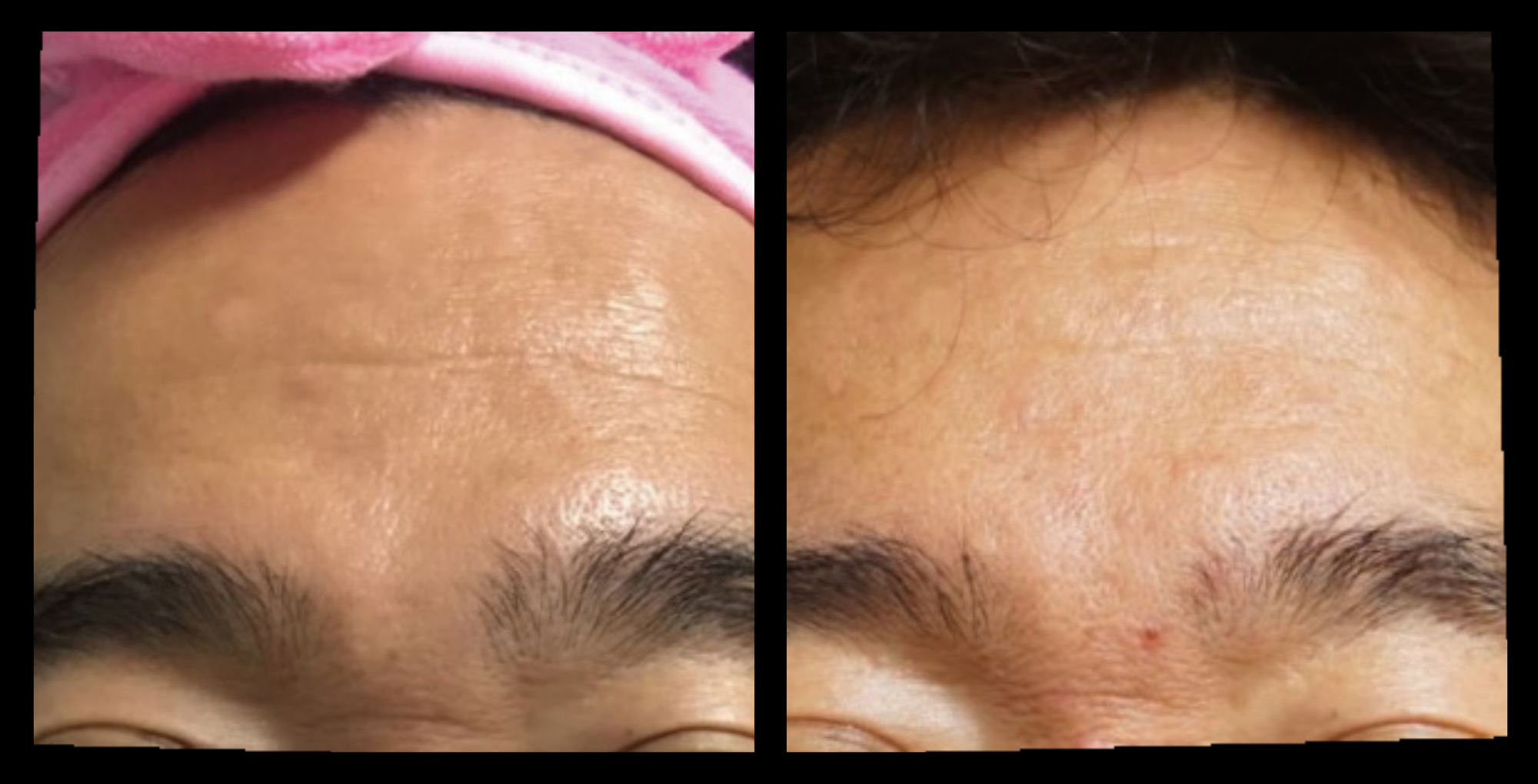 Fractional RF Skin Resurfacing. After 1 Treatment. Photo Courtesy of Asterasys.