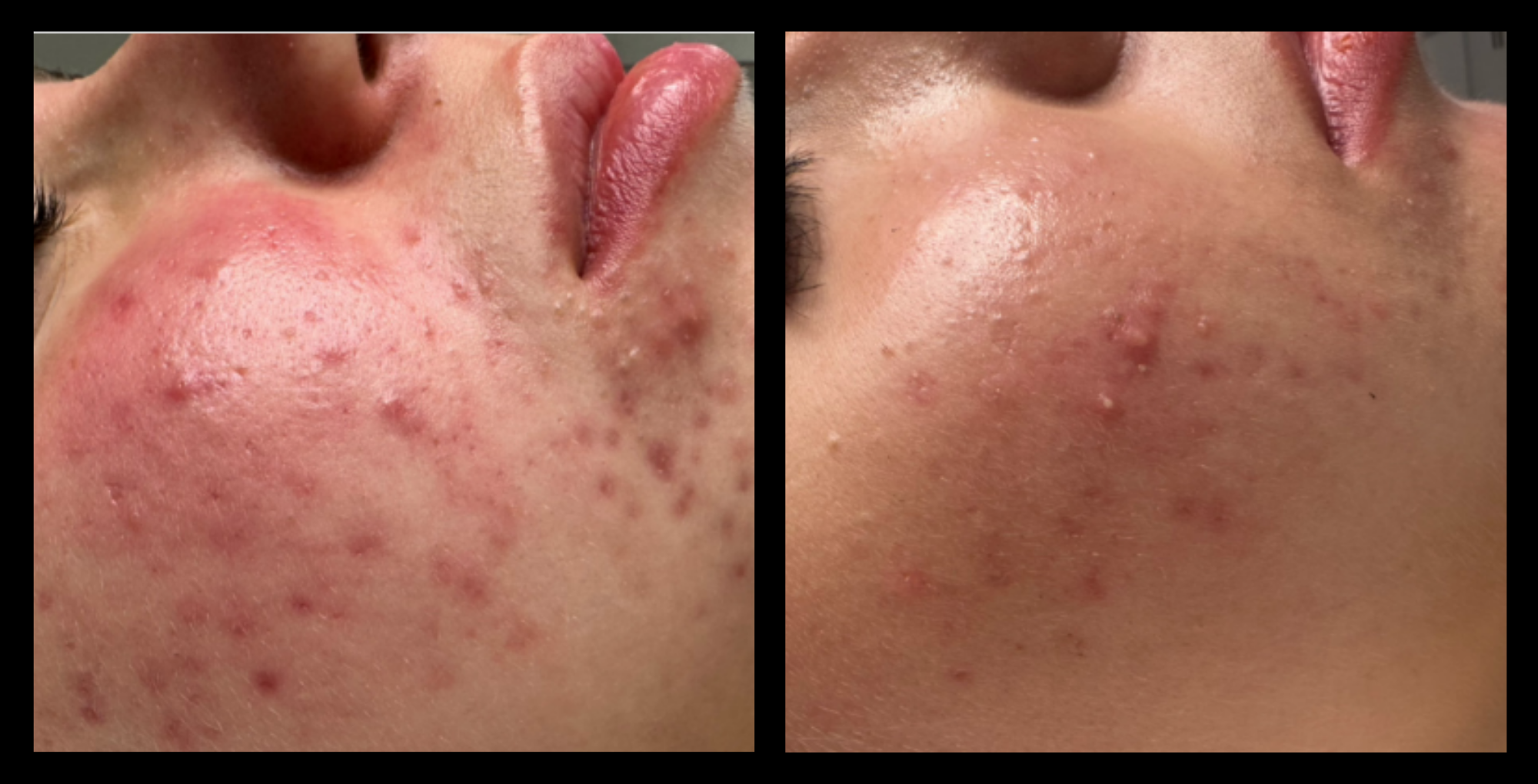 Before and after results of IPL acne management after 6 treatments, demonstrating clearer skin with reduced acne breakouts and inflammation. Treatment performed by Exquise Skin Boutique.