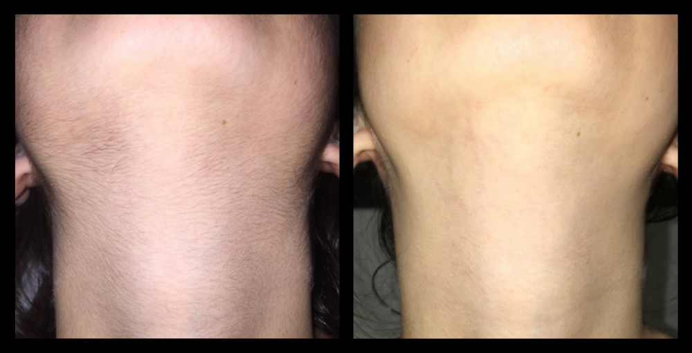 Before and after results of IPL permanent hair removal on the neck after 6 treatments, showing significant hair reduction and smoother skin. Image courtesy of Glow Skin + Body, Doveton, VIC.