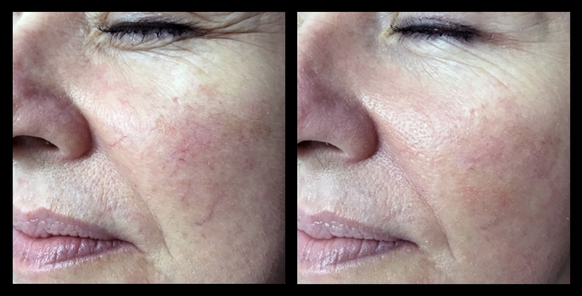 IPL Photo Rejuvenation before and after image showing improved skin clarity, reduced pigmentation, and revitalised complexion after 1 treatment. Courtesy of Rejuv Skin Clinic, Forster, NSW.