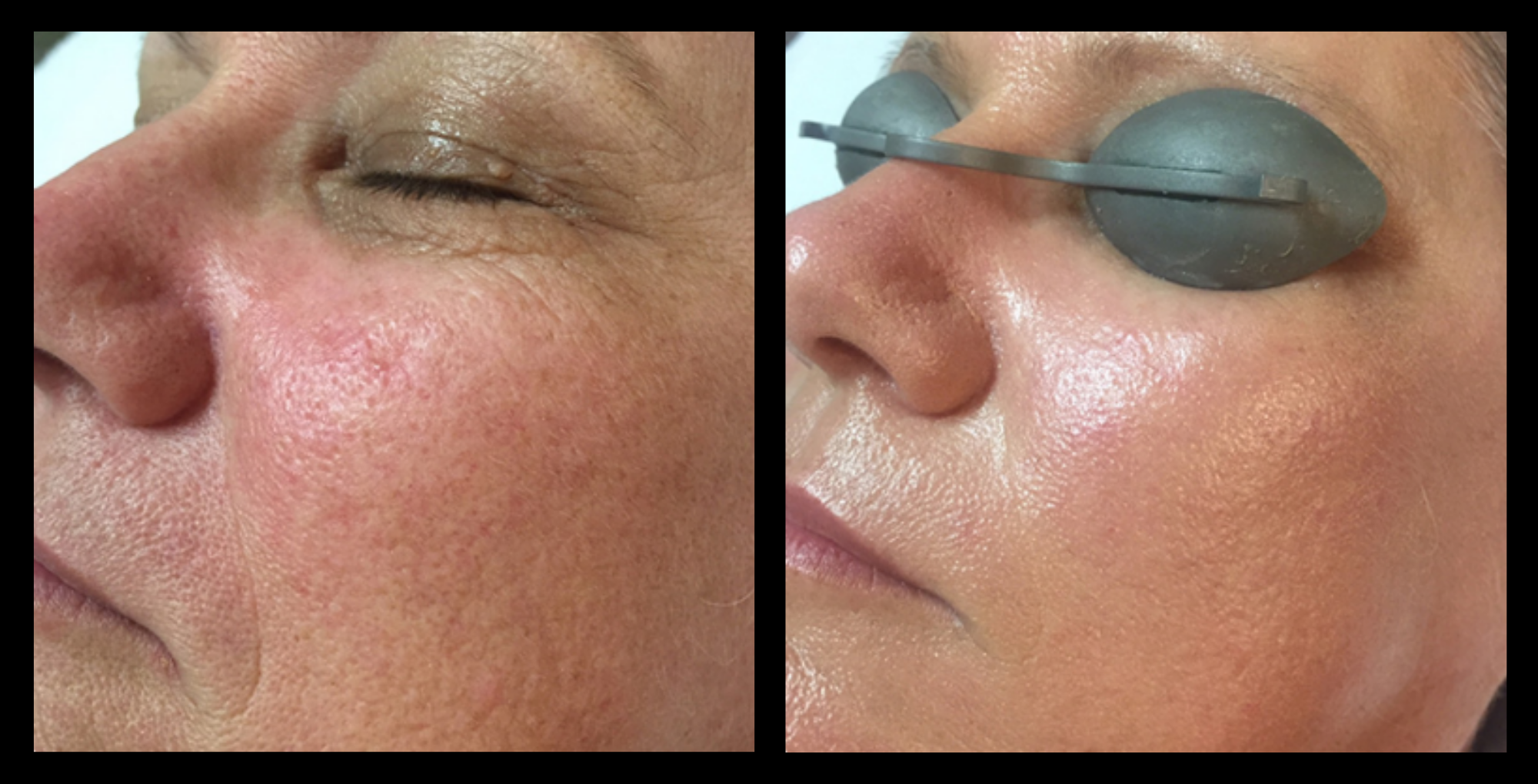 IPL Photo Rejuvenation before and after results showing enhanced skin tone, reduced sun damage, and overall facial rejuvenation after 3 treatments. Courtesy of Boutique of Cosmetic Dermatology, Varsity Lakes, QLD.