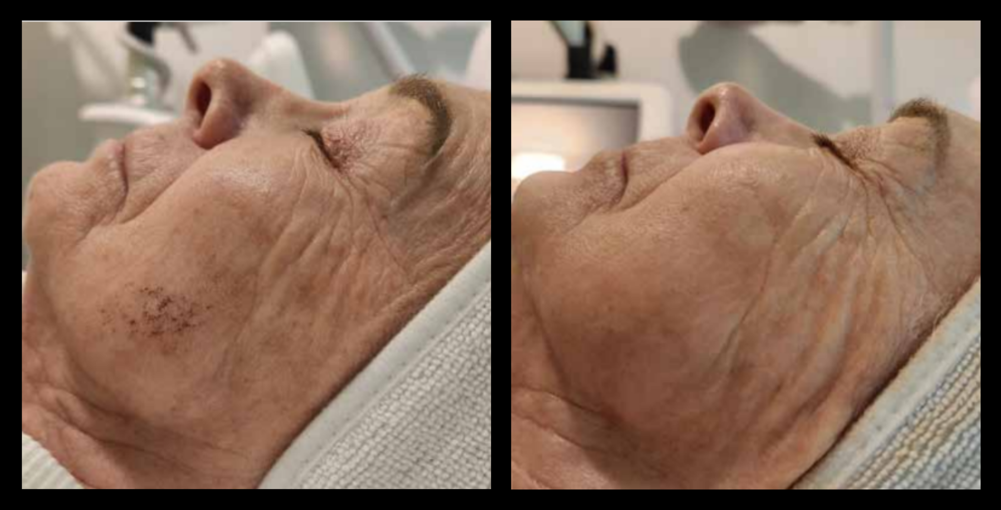 IPL pigmentation correction before and after – 3-treatment results showing reduced pigmentation, clearer skin tone, and rejuvenation. IPL skin treatment by Flora Beauty Station, QLD – trusted provider of IPL in Australia.