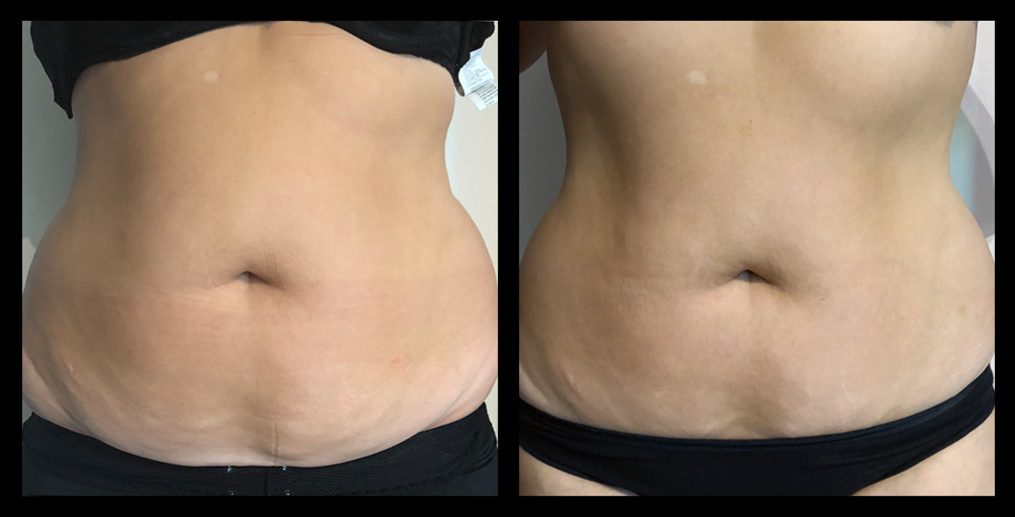 Before and after results from LUX Series ultrasound body contouring on the abdomen. Treatment available on UltraLUX, UltraLUX PRO, and SlimLUX devices. Visible reduction in abdominal circumference and a more sculpted, toned appearance.