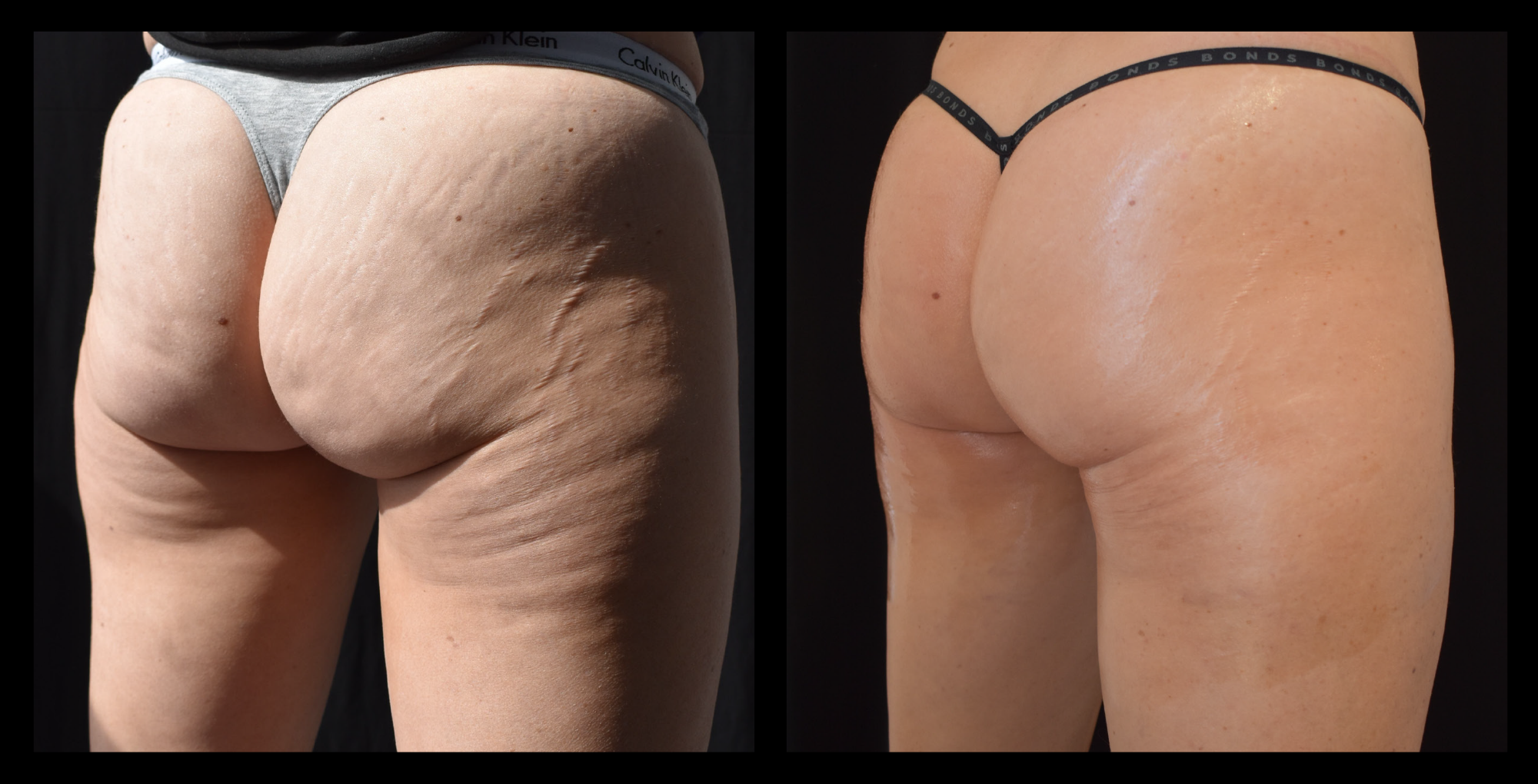 Before and after results from LUX Series body contouring on the buttocks. Treatment available on UltraLUX, UltraLUX PRO, and SlimLUX devices. Visible lifting and firming of the buttocks with a noticeable reduction in the appearance of skin laxity for a smoother, more toned result.