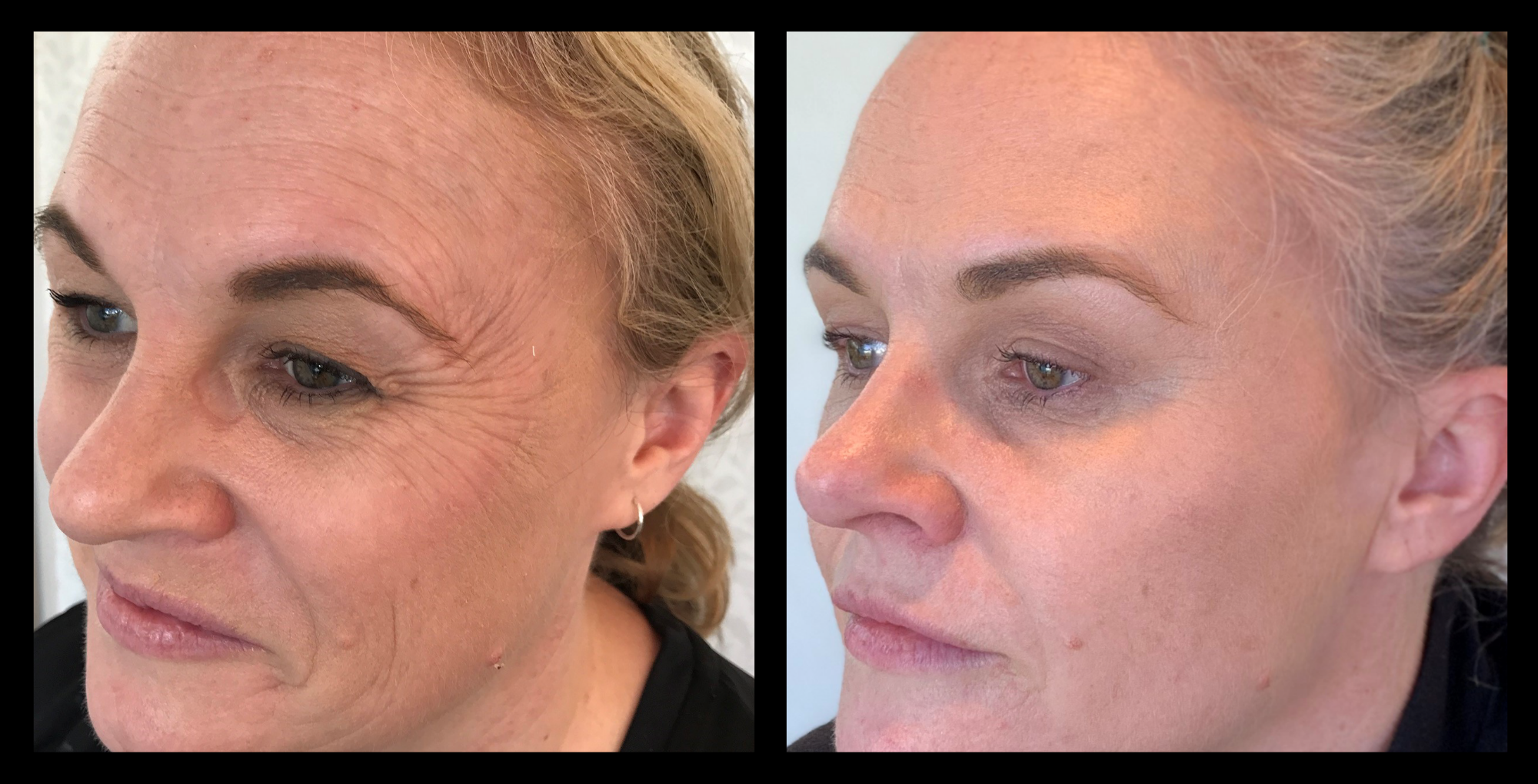 RF Skin Tightening + Skin Needling After 4 Treatments. Photo courtesy of Beauty on Latrobe, Paddington, QLD.