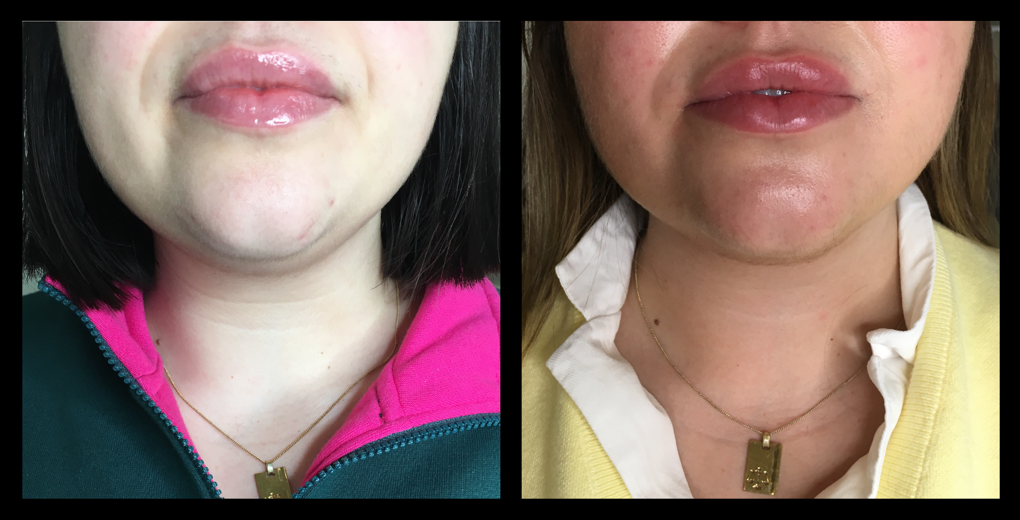 RF Skin Tightening After 4 Treatments. Photo courtesy of Sculpt and Skin, Skye, VIC.