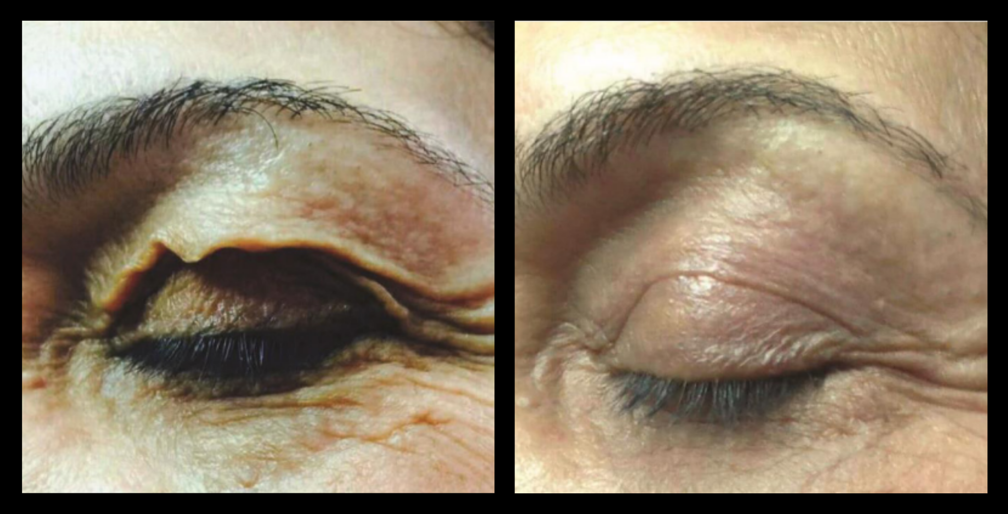 Blepharoplasty before and after results showing lifted, rejuvenated upper eyelids after treatment at GMV, Italy – non-surgical eye lift improvement in skin firmness and eye contour.