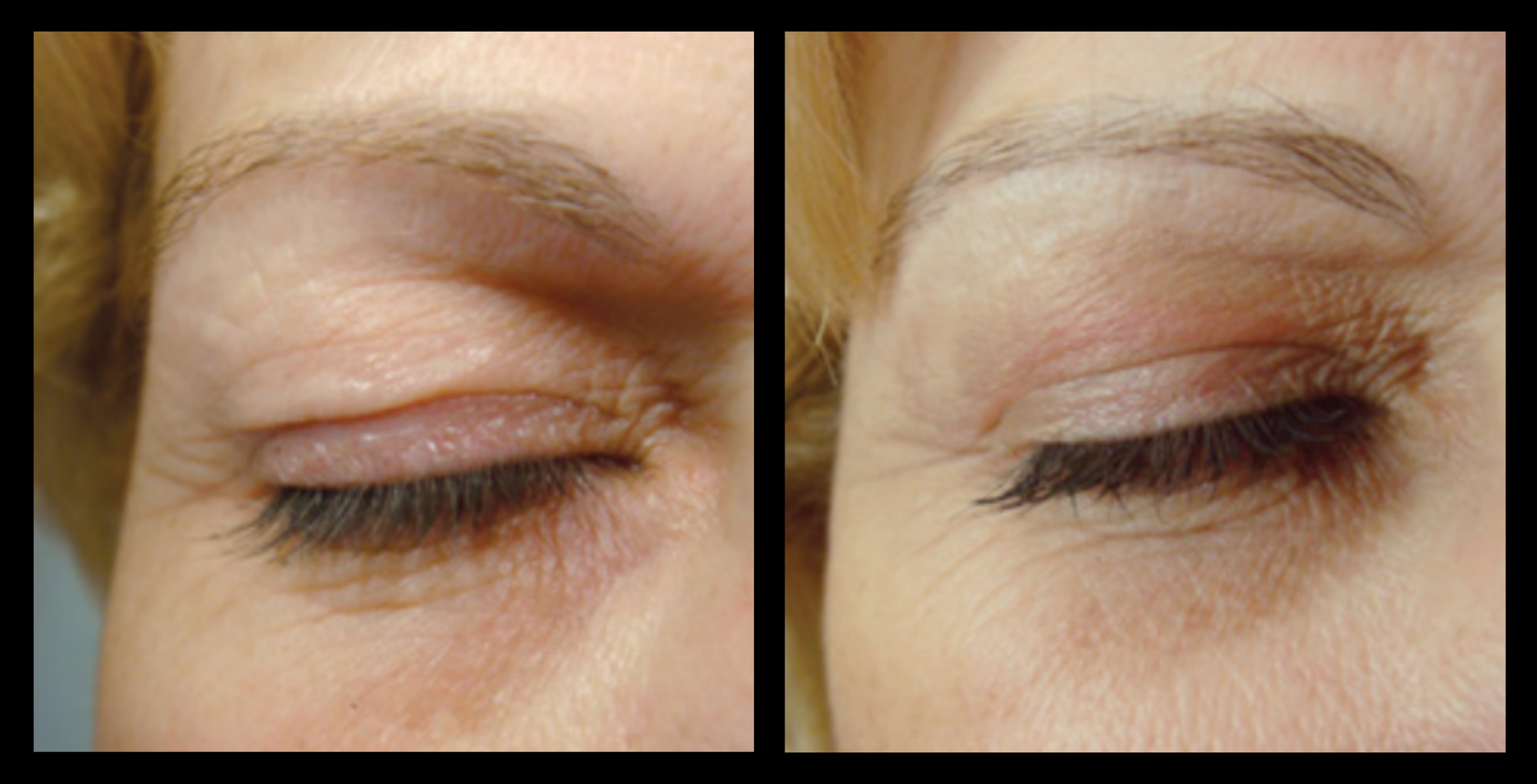 Blepharoplasty before and after results showing lifted, rejuvenated upper eyelids after treatment at GMV, Italy – non-surgical eye lift improvement in skin firmness and eye contour.