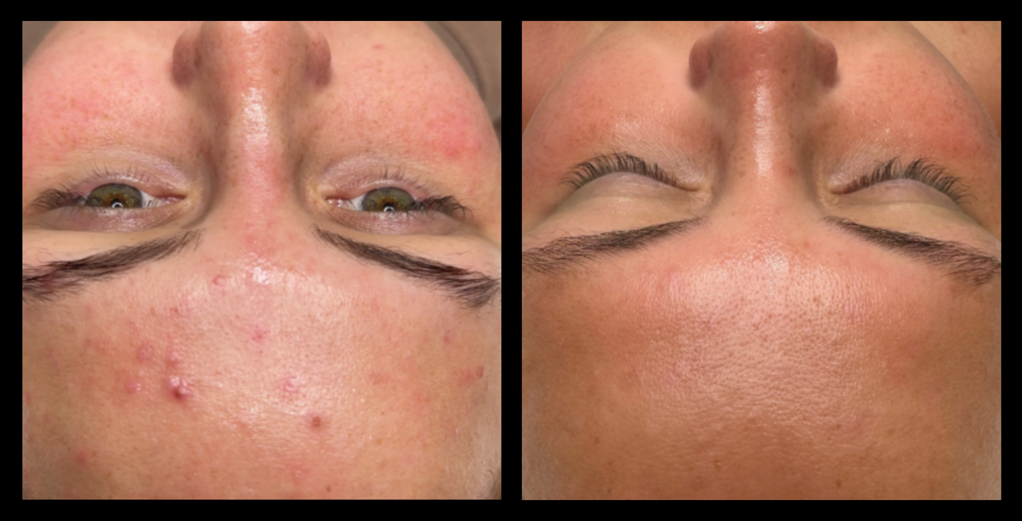 Before and after results of Carbon Facial, Hydrodermabrasion, and LED Light Therapy after 4 treatments at Exquise Skin Boutique, Harrington Park, NSW. Noticeable improvements in skin clarity, brightness, and texture—ideal for acne-prone, congested, or dull skin. A top skin rejuvenation solution combining exfoliation, detoxification, and LED light therapy benefits.