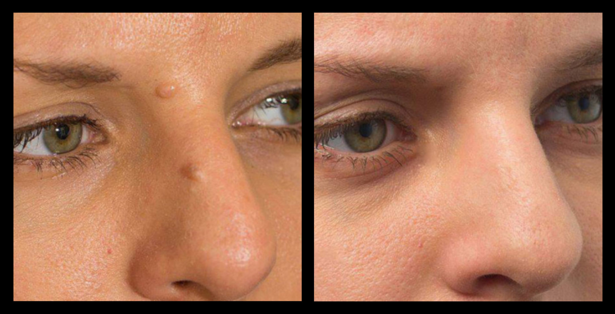 Before and after image showing removal of cutaneous neoformations after treatment at GMV, Italy – visible skin improvement and lesion reduction with non-invasive dermatological procedure.