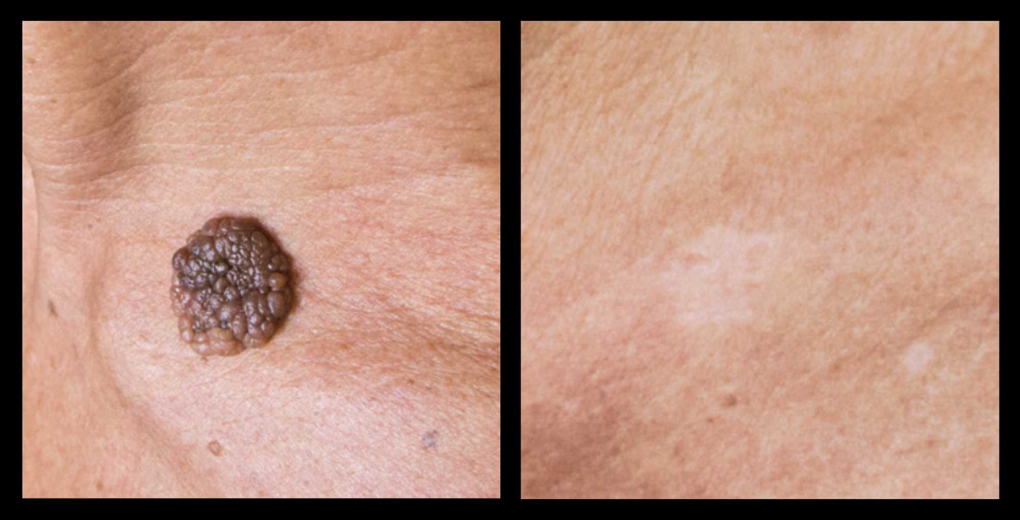 Before and after image showing removal of cutaneous neoformations after treatment at GMV, Italy – visible skin improvement and lesion reduction with non-invasive dermatological procedure.