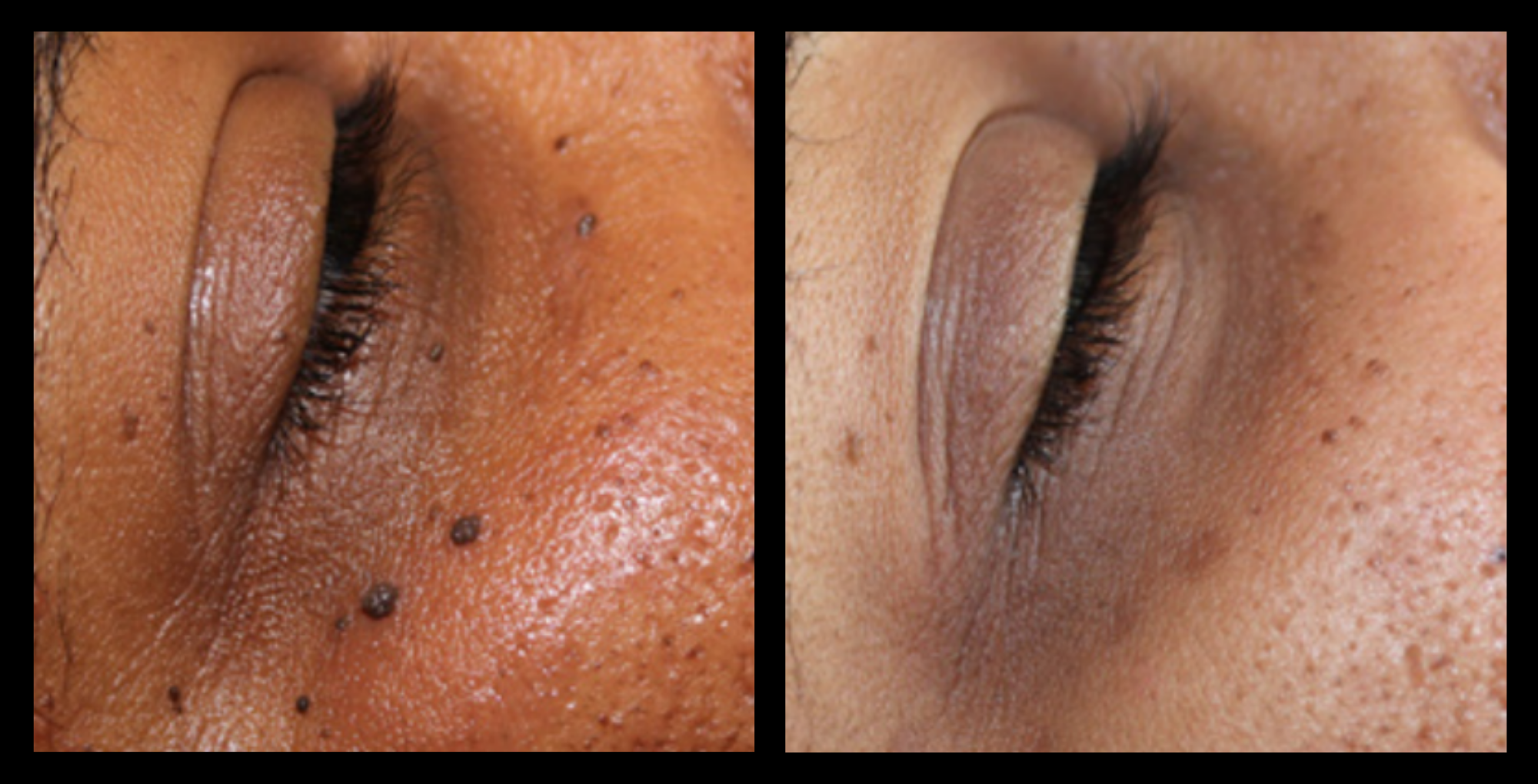 Before and after image showing removal of cutaneous neoformations after treatment at GMV, Italy – visible skin improvement and lesion reduction with non-invasive dermatological procedure.