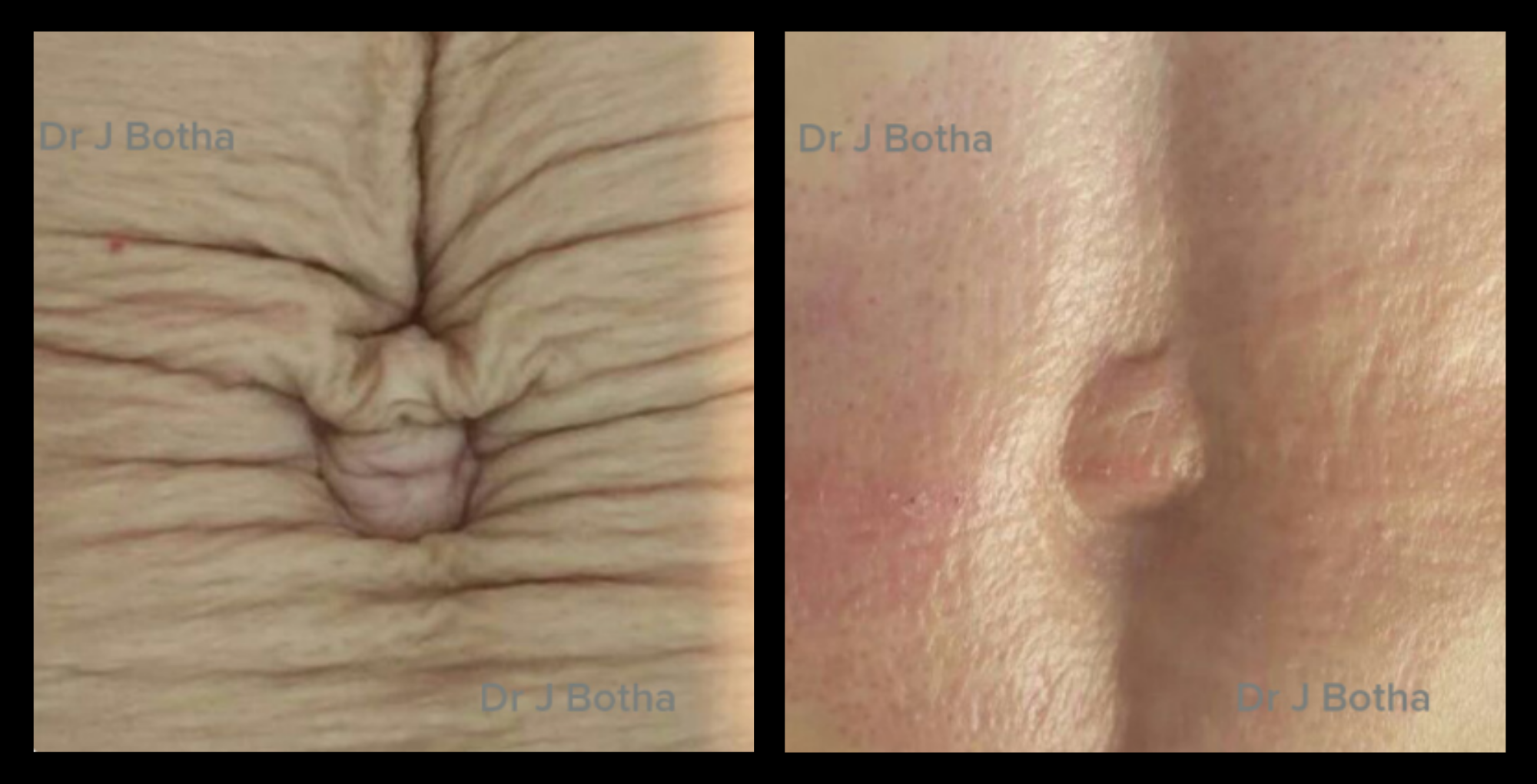 Before and after results of elastic skin reduction treatment using advanced technology at GMV, Italy – visible improvement in skin firmness and reduced skin laxity.