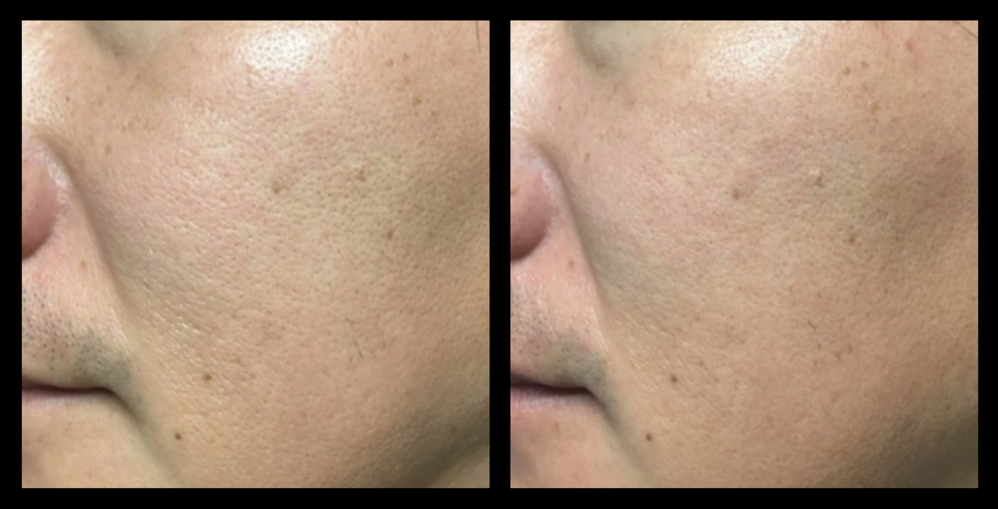 Fractional RF skin resurfacing before and after photo after 1 treatment showing smoother skin texture and reduced pigmentation. Courtesy of Asterasys.