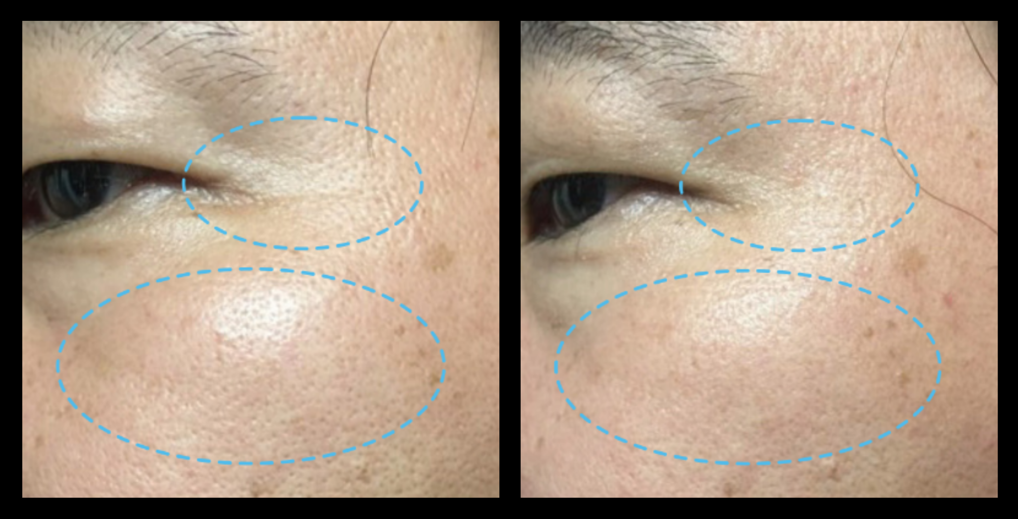 Before and after 1 treatment with Fractional RF Skin Resurfacing—improved skin clarity, reduced texture and pigmentation. Non-surgical facial rejuvenation results. Photo courtesy of Asterasys.