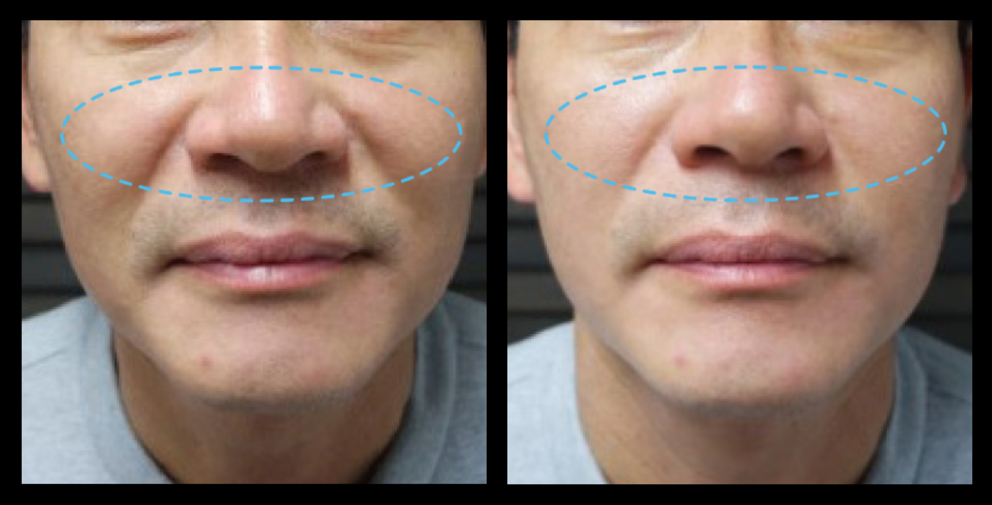 Fractional RF Skin Resurfacing before and after 1 treatment—visible improvement in skin tone, texture, and fine lines. Non-invasive facial rejuvenation results. Photo courtesy of Asterasys.