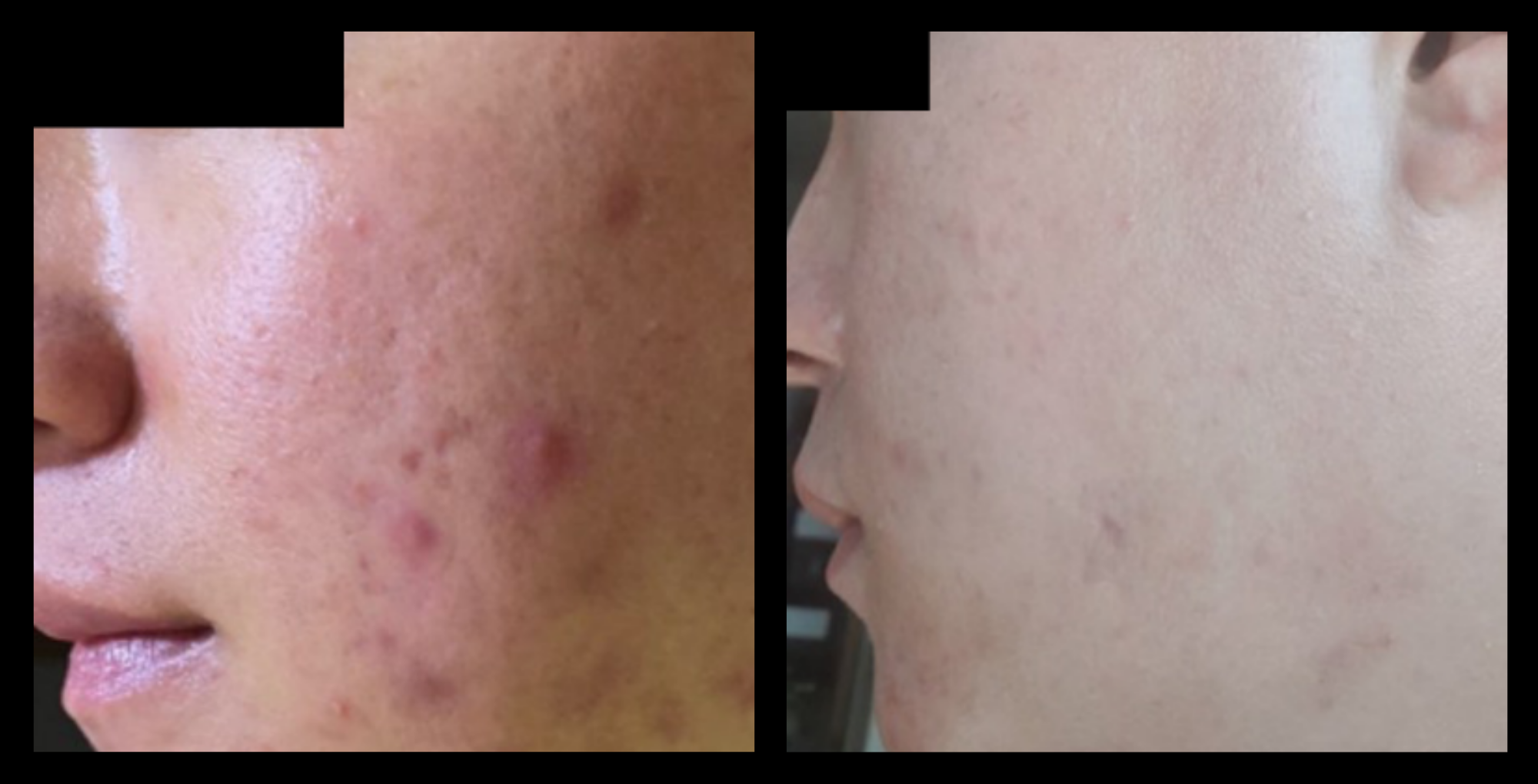 Fractional RF Skin Resurfacing devuce before and after 1 treatment—visible improvement in skin tone, texture, and fine lines. Non-invasive facial rejuvenation results. Photo courtesy of Asterasys.