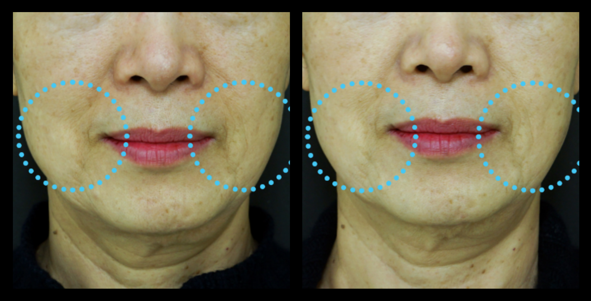 Before and after HIFU non-surgical face lift results after 1 treatment, showing visible facial skin tightening and improved jawline definition. Photo courtesy of Asterasys. HIFU face lift for non-surgical anti-aging, collagen stimulation, and contour enhancement.