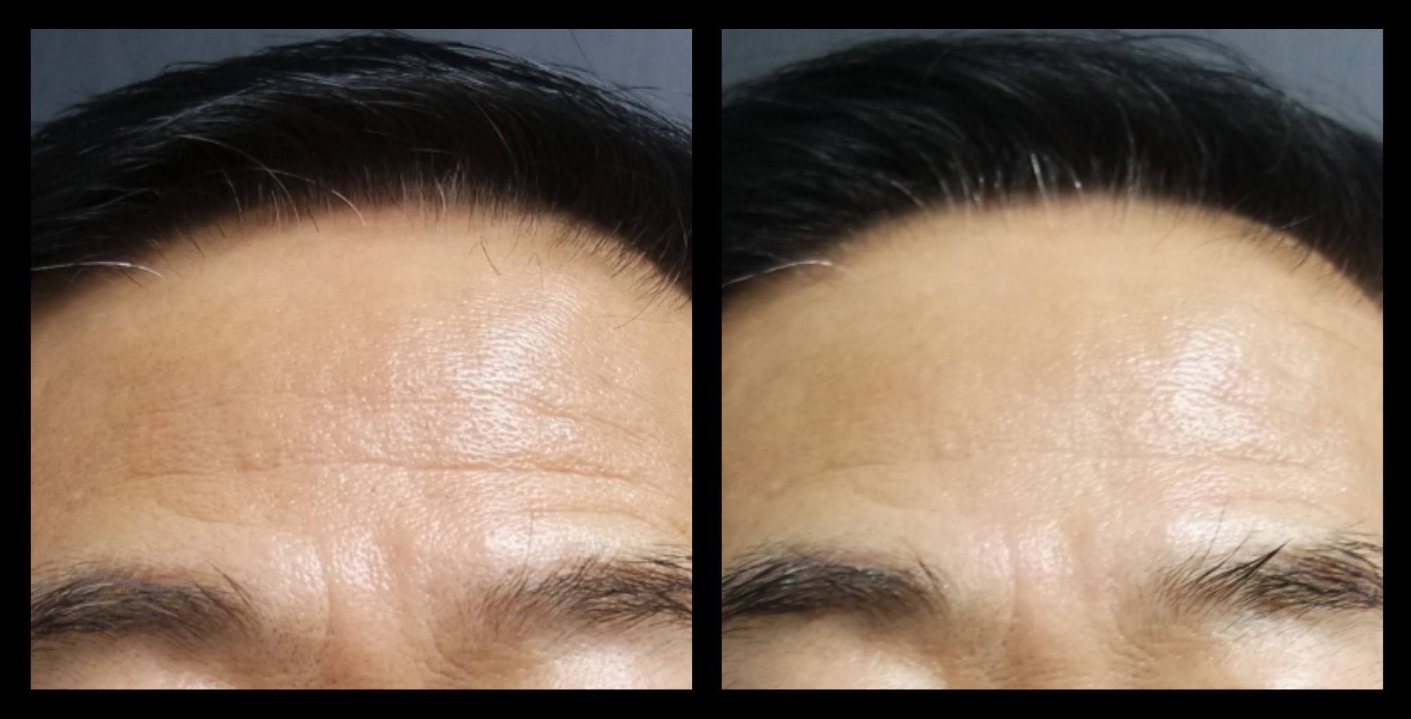 Before and after HIFU non-surgical face lift results after 1 treatment, showcasing lifted cheeks, firmer skin, and a more defined facial contour. Photo courtesy of Asterasys. HIFU face lift treatment for non-invasive skin tightening, wrinkle reduction, and facial rejuvenation.