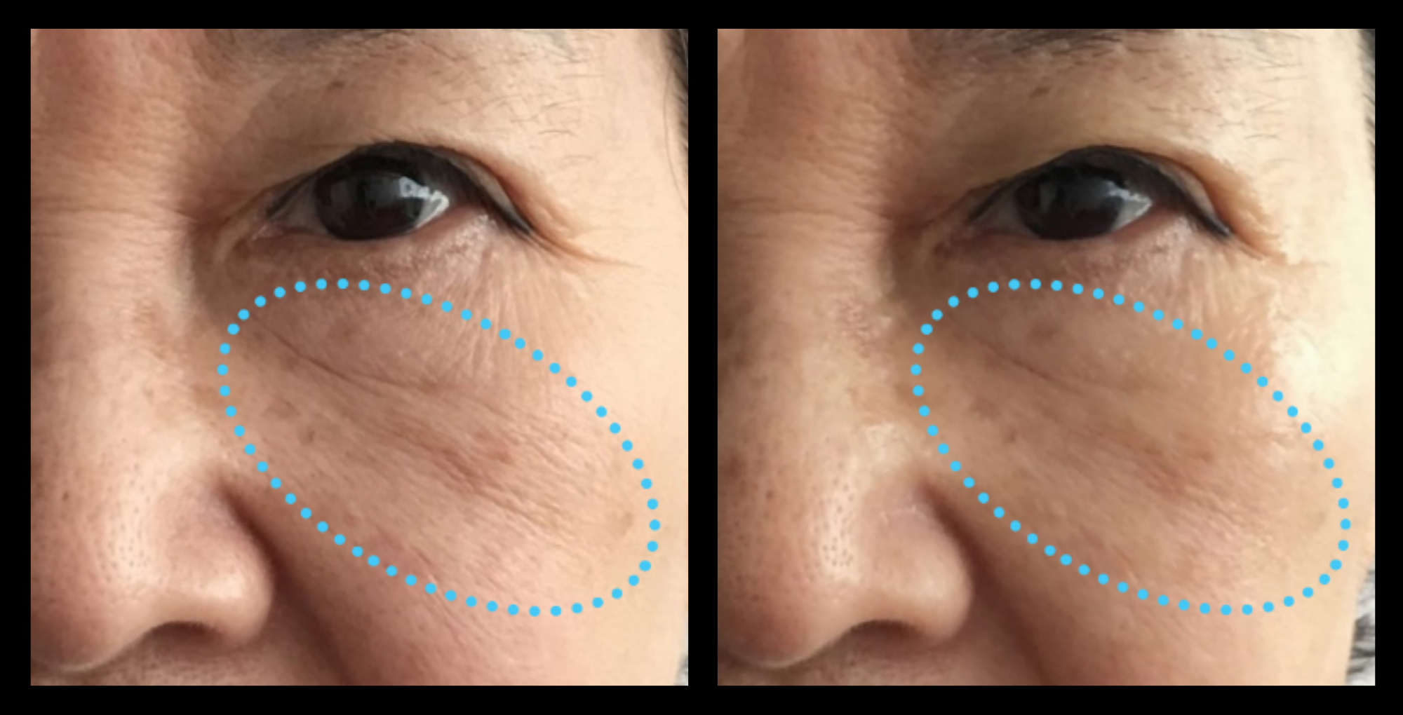 Before and after HIFU non-surgical face lift results after 1 treatment, showcasing lifted cheeks, firmer skin, and a more defined facial contour. Photo courtesy of Asterasys. HIFU face lift treatment for non-invasive skin tightening, wrinkle reduction, and facial rejuvenation.