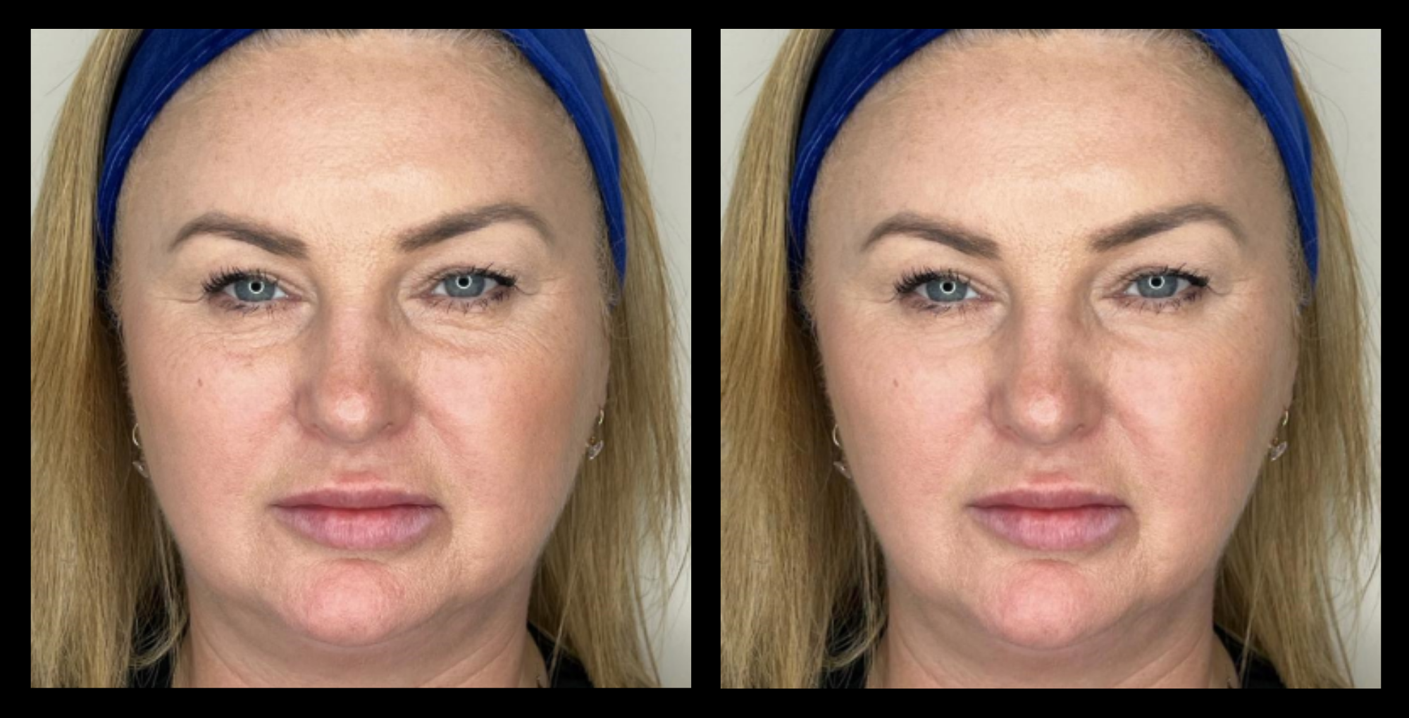 HIFU non-surgical face lift before and after results after 2 treatments – visible skin tightening and wrinkle reduction. Photo courtesy of Asterasys.