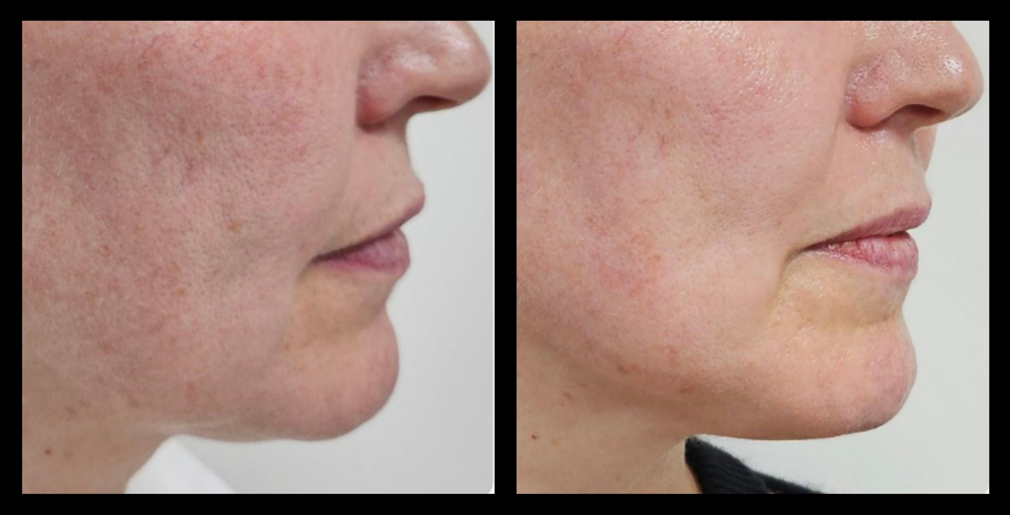 HIFU device non-surgical face lift results after 2 treatments showing noticeable skin tightening and wrinkle reduction. Photo courtesy of The Global Beauty Group.