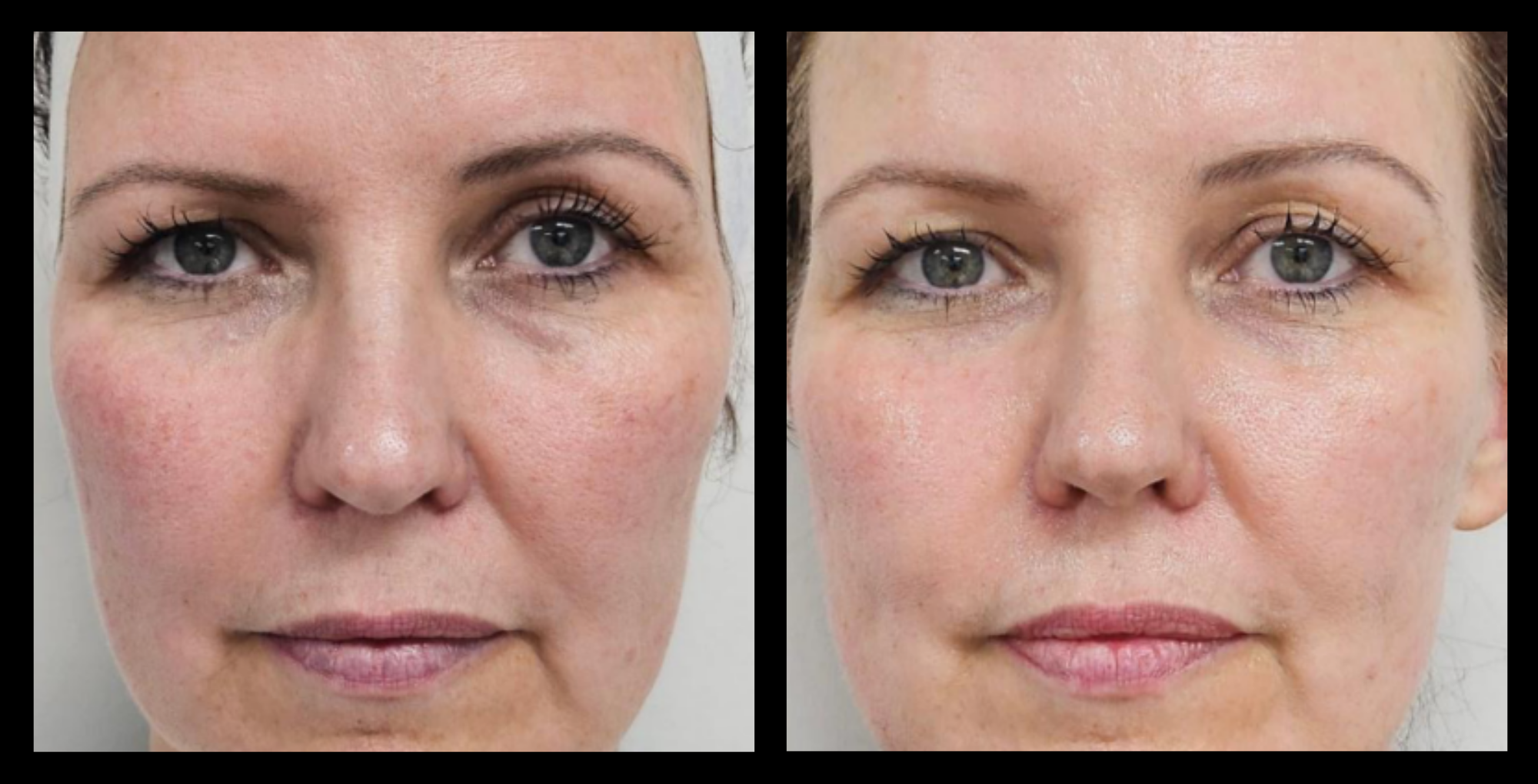 HIFU device non-surgical face lift results after 1 treatment showing visible skin lifting and improved facial contour. Photo courtesy of The Global Beauty Group.