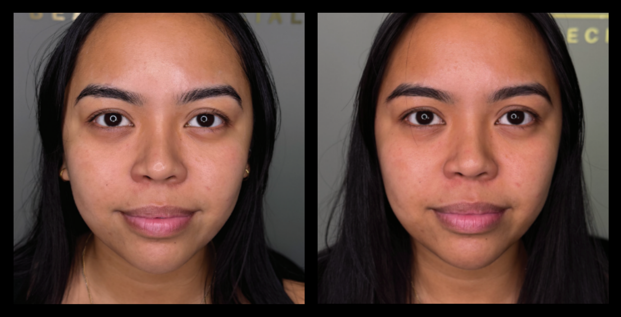 HIFU non-surgical face lift before and after results after 1 treatment, highlighting skin tightening and facial rejuvenation. Photo courtesy of Claudia Jade Pty Ltd, Colebee, NSW.