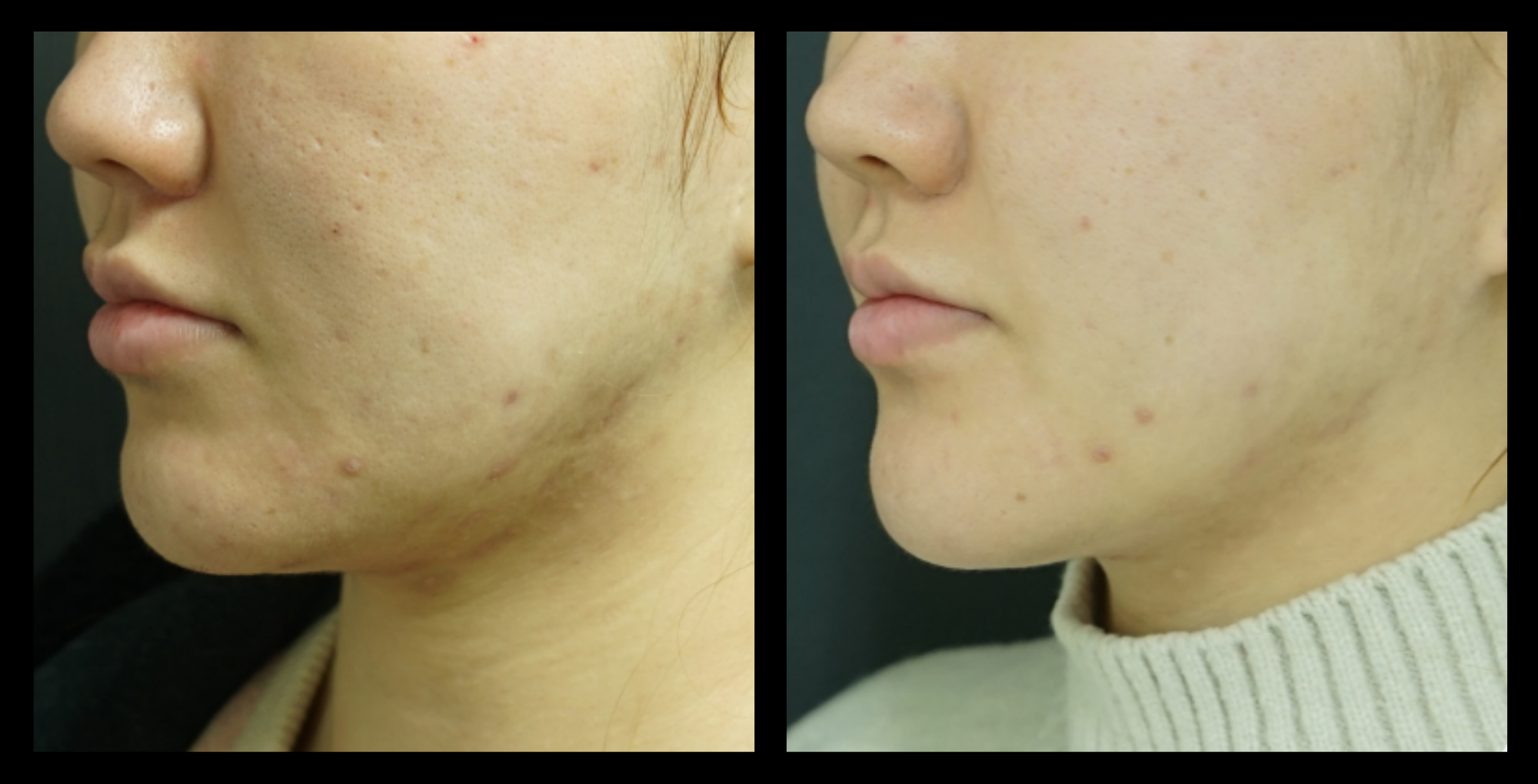 Before and after HIFU non-surgical neck lift results after 1 treatment, showing noticeable reduction in neck sagging and enhanced skin firmness. Photo courtesy of Asterasys. HIFU skin tightening for non-invasive neck lift and anti-aging results.