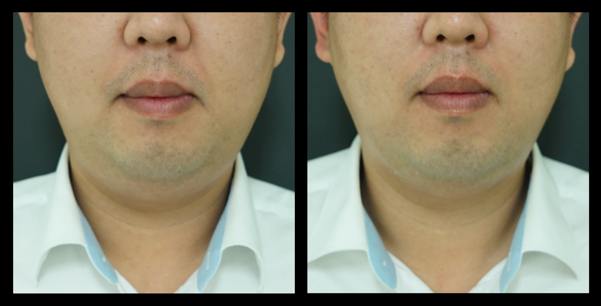 Before and after HIFU non-surgical neck lift results after 1 treatment, showing noticeable lifting and firmer neck skin. Photo courtesy of Asterasys. Non-invasive HIFU treatment for neck tightening, collagen stimulation, and anti-aging benefits.