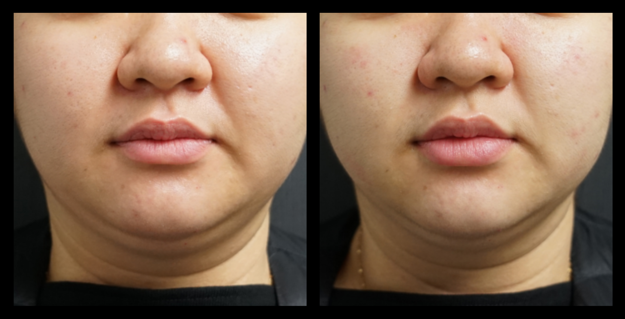Before and after HIFU devicemachine non-surgical face lift results after 1 treatment, showing lifted facial contours and improved skin firmness. Photo courtesy of Asterasys. HIFU face lift for non-invasive facial rejuvenation, wrinkle reduction, and skin tightening.