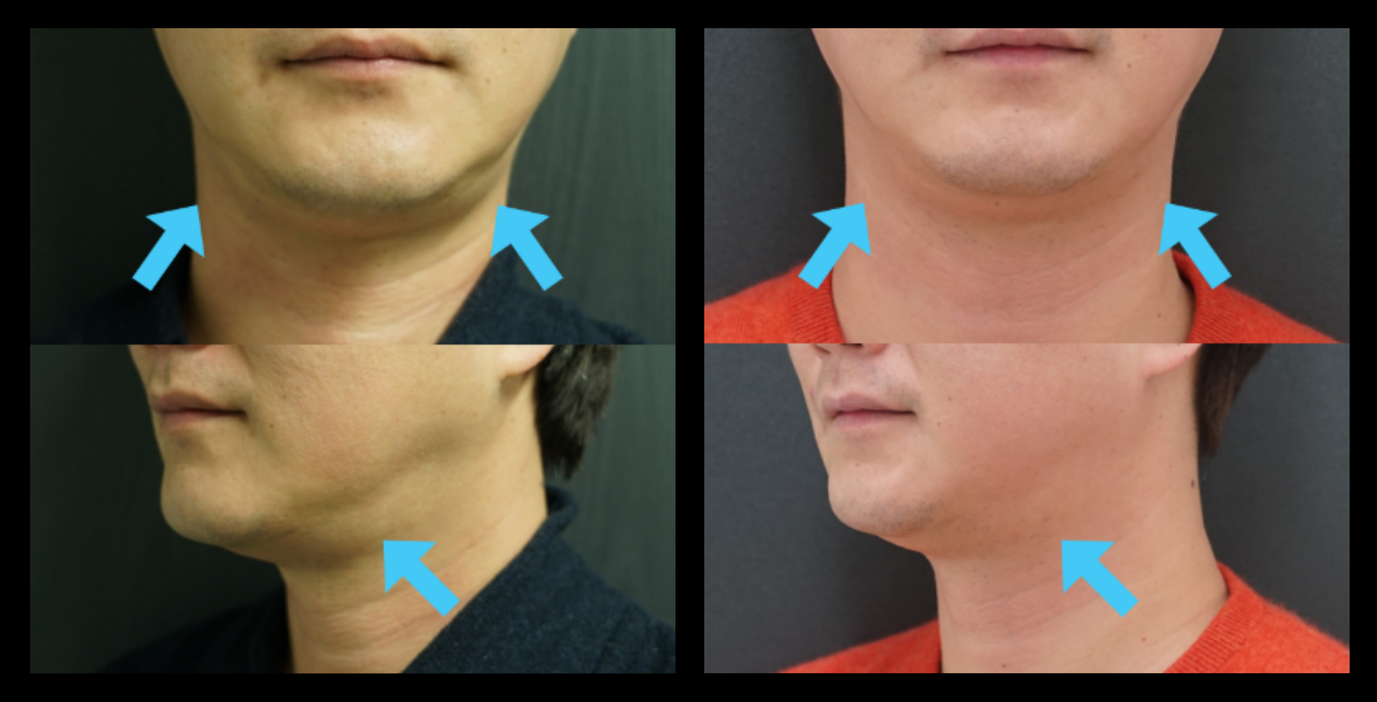 Before and after HIFU non-surgical neck lift results after 1 treatment, illustrating visible skin tightening and improved neck tone. Photo courtesy of Asterasys. HIFU neck lift for non-surgical skin rejuvenation, contour enhancement, and collagen stimulation.