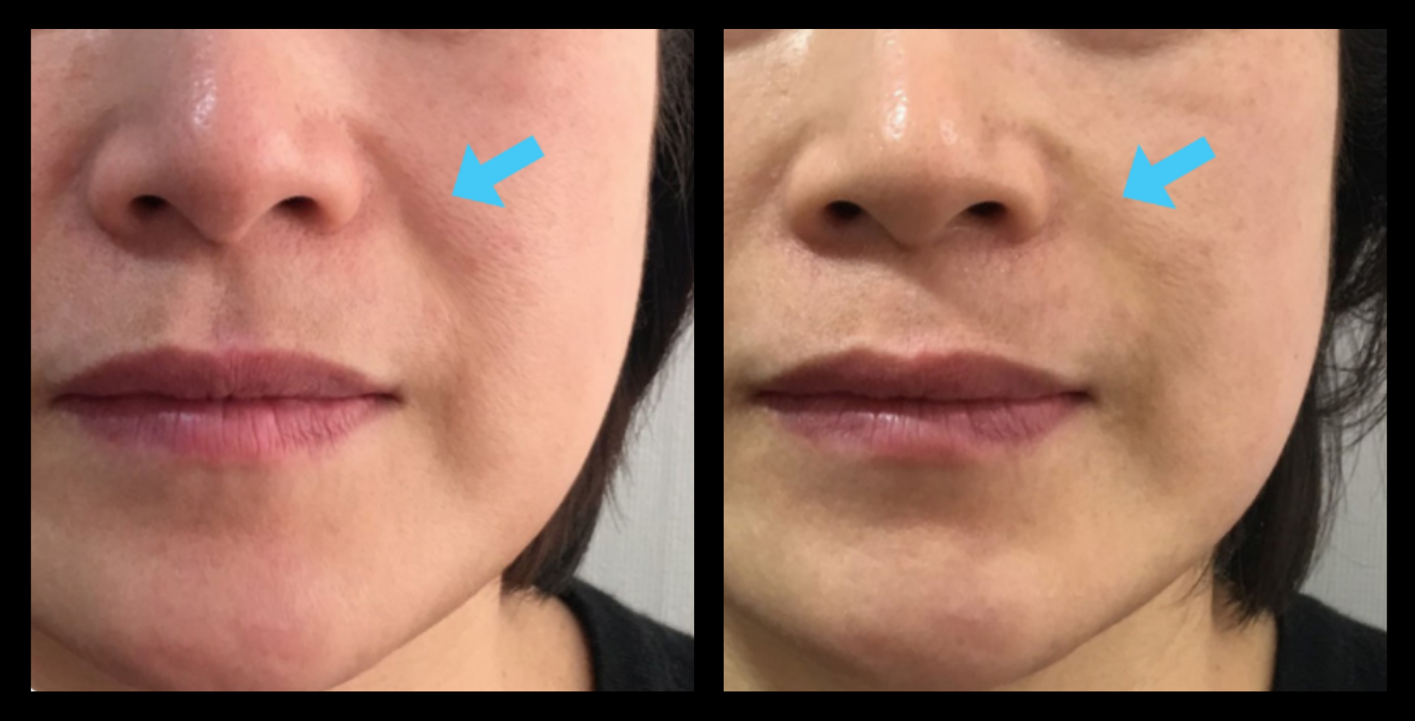 Before and after HIFU non-surgical face lift results after 1 treatment, highlighting tighter skin, reduced fine lines, and enhanced facial definition. Photo courtesy of Asterasys. Non-invasive HIFU treatment for face lifting, collagen boost, and anti-aging skin rejuvenation.