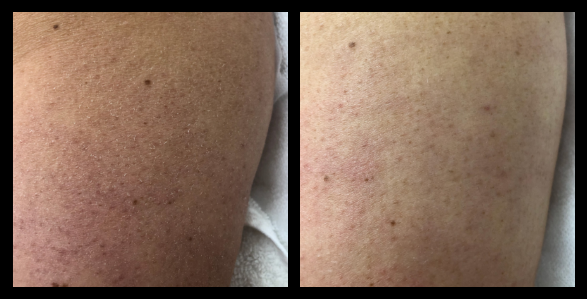 Before and after results of Hydro microdermabrasion machine with Hydro Infusion after 1 treatment using The Global Beauty Group technology — visibly brighter, smoother, and deeply hydrated skin.