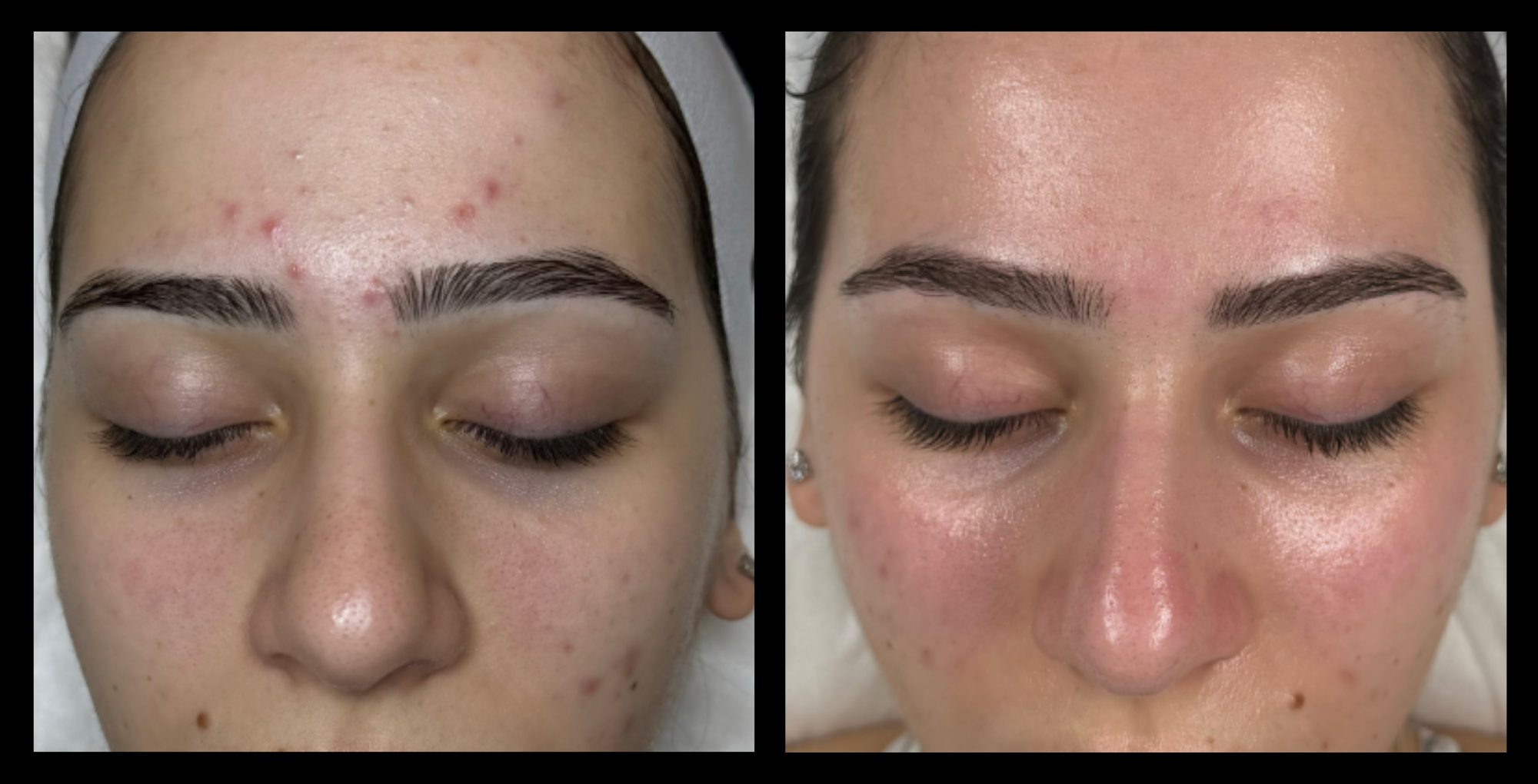 Before and after results of Hydro microdermabrasion machine and Hydro Infusion after 4 treatments at Angelic Skin & Beauty, VIC, showing improved skin texture, hydration, and overall radiance.