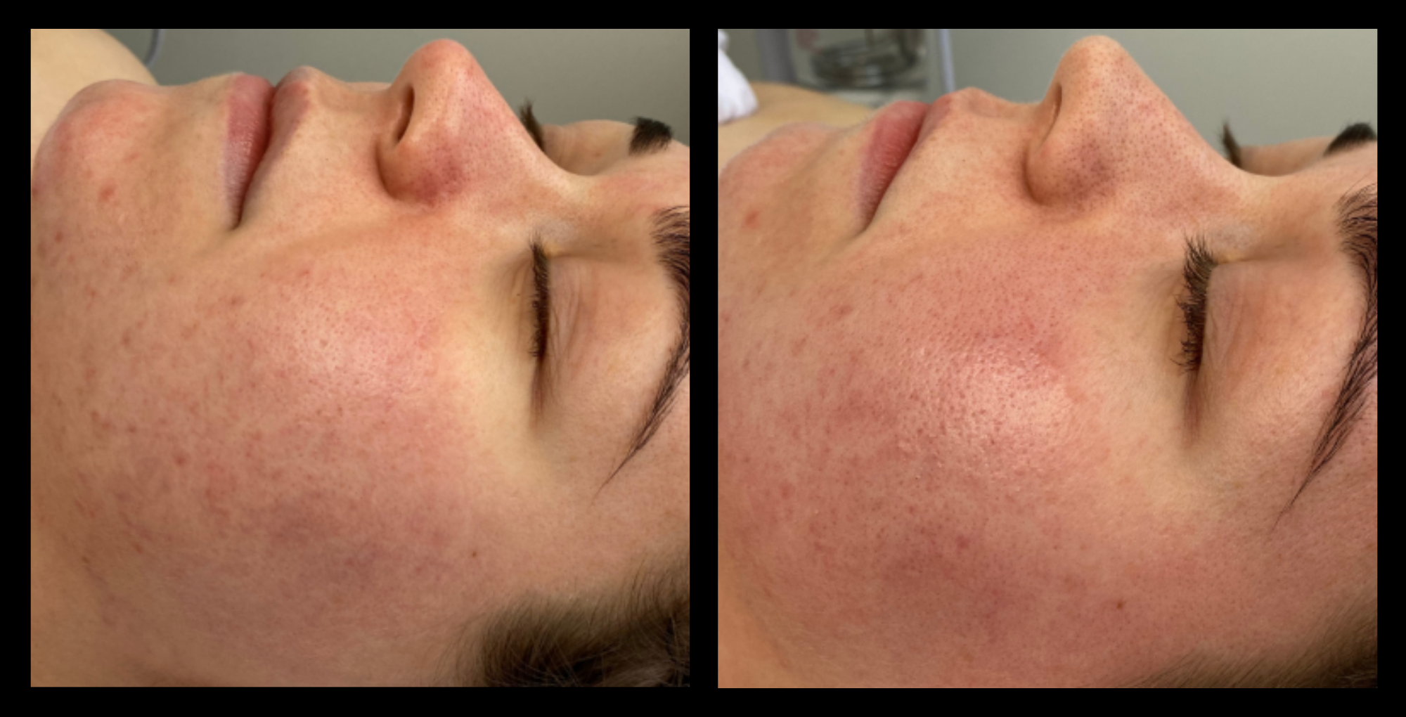 Hydro microdermabrasion machine treatment before and after results after 1 session at Ritual Skin Clinic, Canley Heights NSW — visibly clearer, smoother, and more hydrated skin.