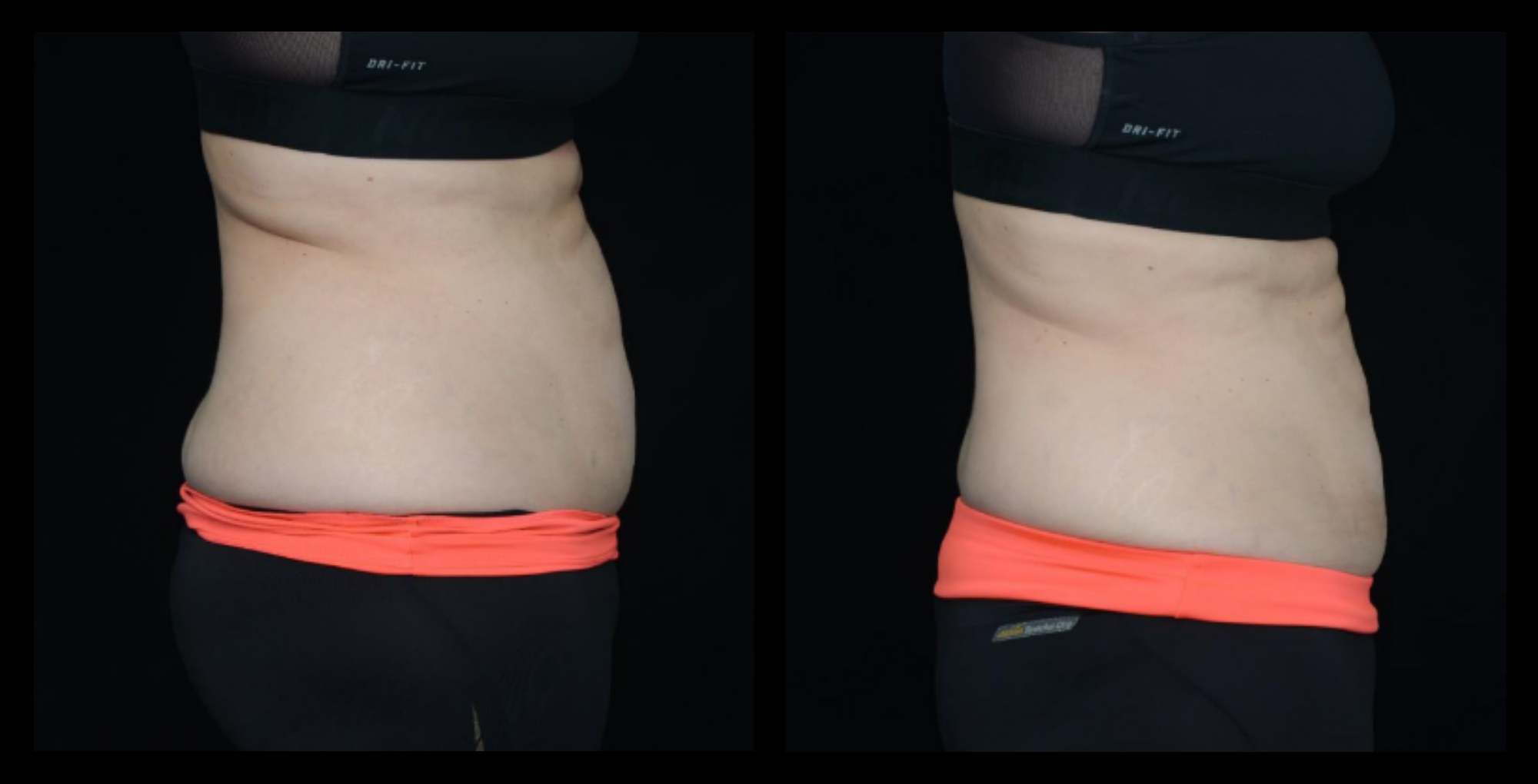 Before and after results of medical-grade fat reduction machine treatment after 2 sessions, showing visible body contouring improvement. Image courtesy of Lightfective. Ideal for showcasing non-invasive fat reduction solutions.