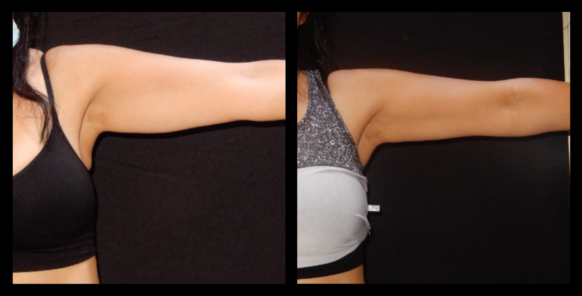 Before and after image of medical-grade fat reduction on arms after 2 treatments, highlighting visible reduction in arm circumference and improved contour. Photo courtesy of Lightfective.