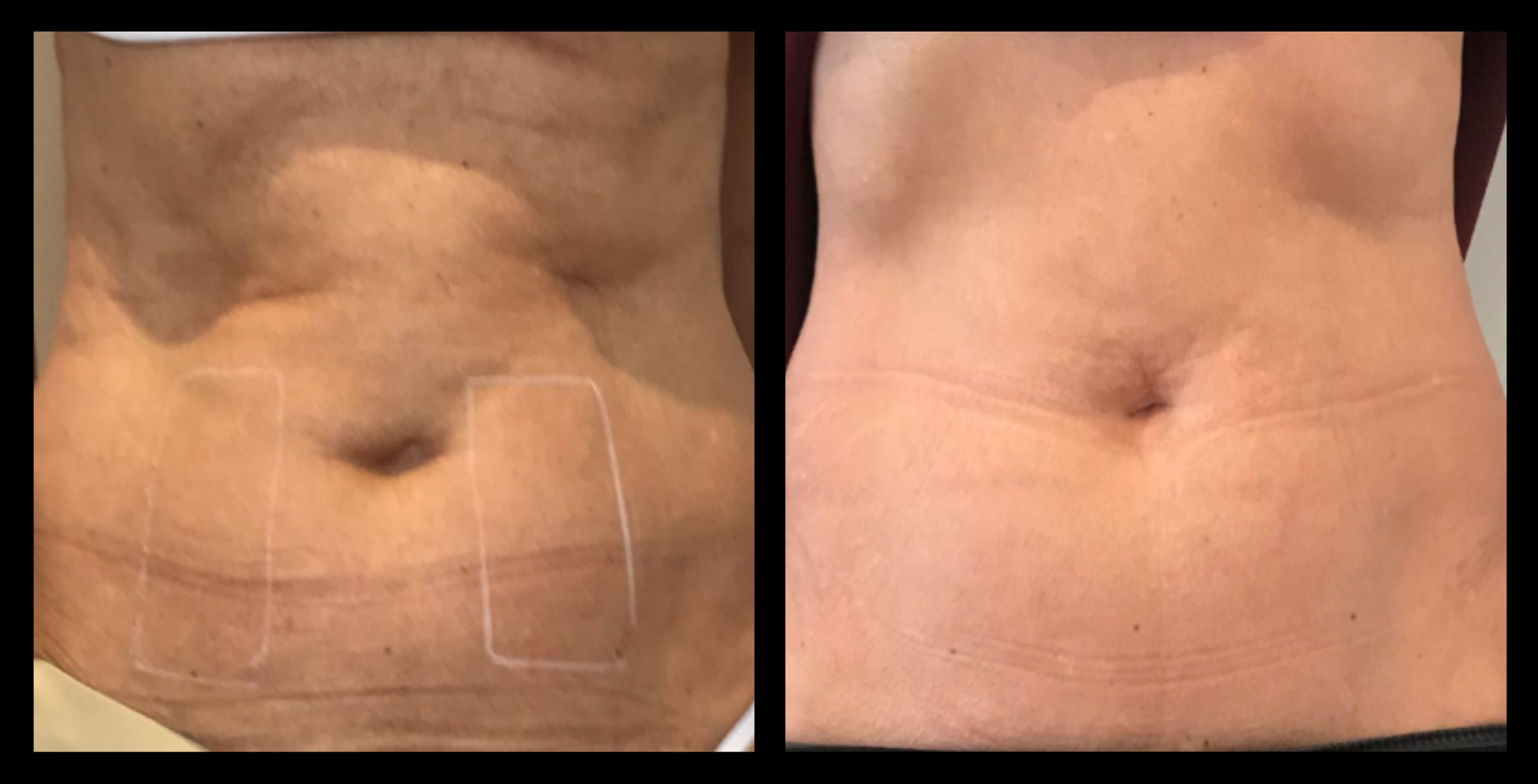 Before and after image of medical-grade fat reduction machine treatment on abdomen after 2 treatments, showing noticeable slimming and improved abdominal contour. Photo courtesy of Lightfective.