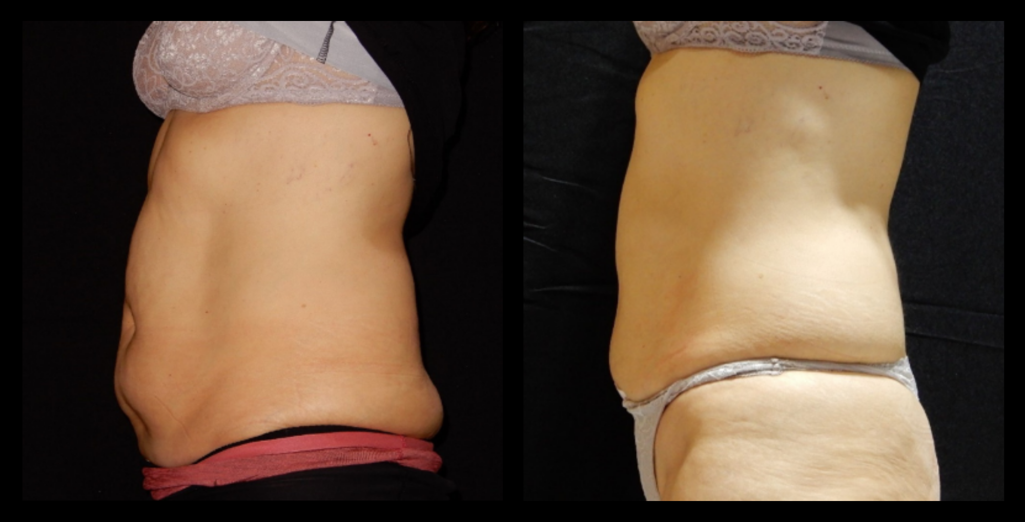 Before and after image of medical-grade fat reduction machine on abdomen after 2 treatments, showing noticeable slimming and improved abdominal contour. Photo courtesy of Lightfective.