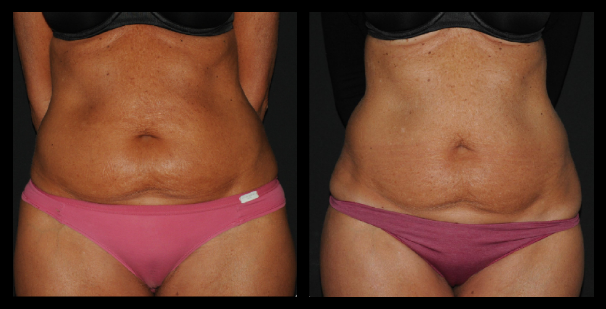 Before and after image of medical-grade fat reduction machine treatment on abdomen after 2 sessions, showing noticeable slimming and improved abdominal contour. Photo courtesy of Lightfective.