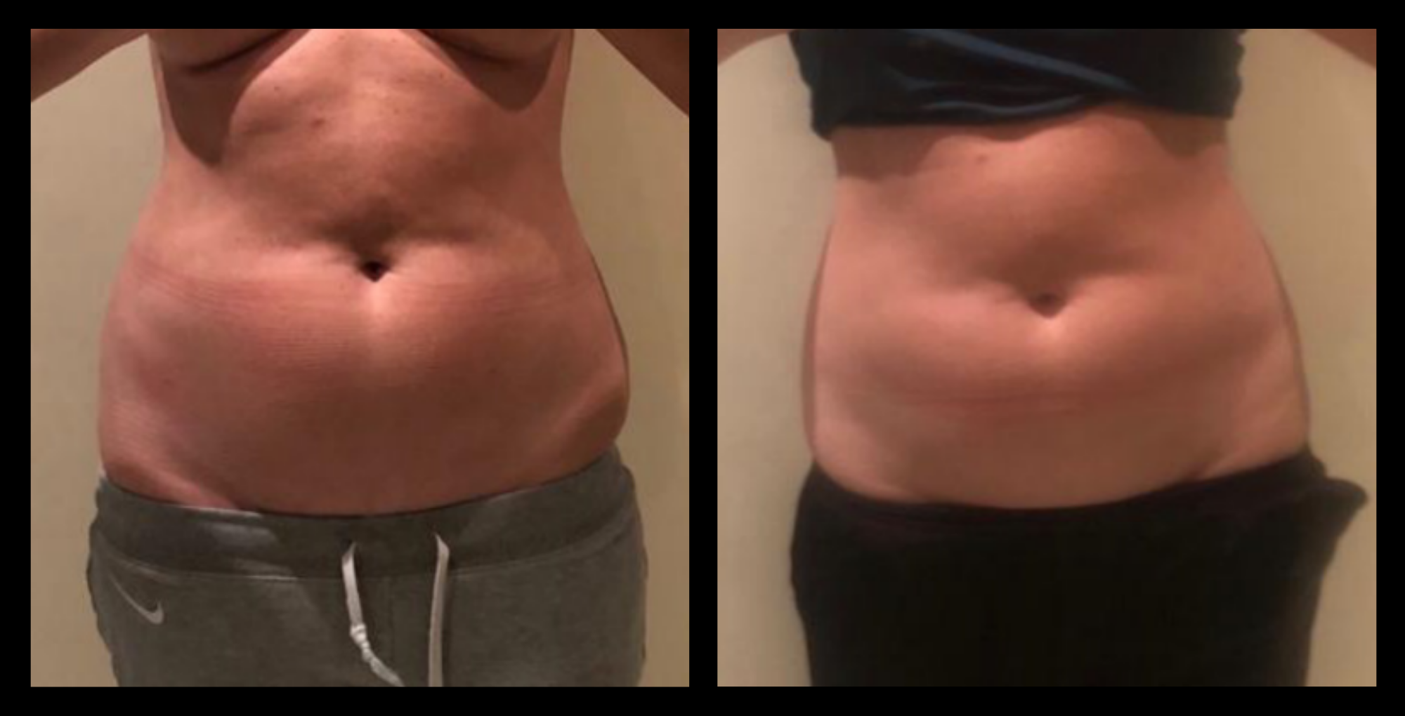 Before and after image of medical-grade fat reduction machine on abdomen after 2 treatments, showing noticeable slimming and improved abdominal contour. Photo courtesy of Lightfective.