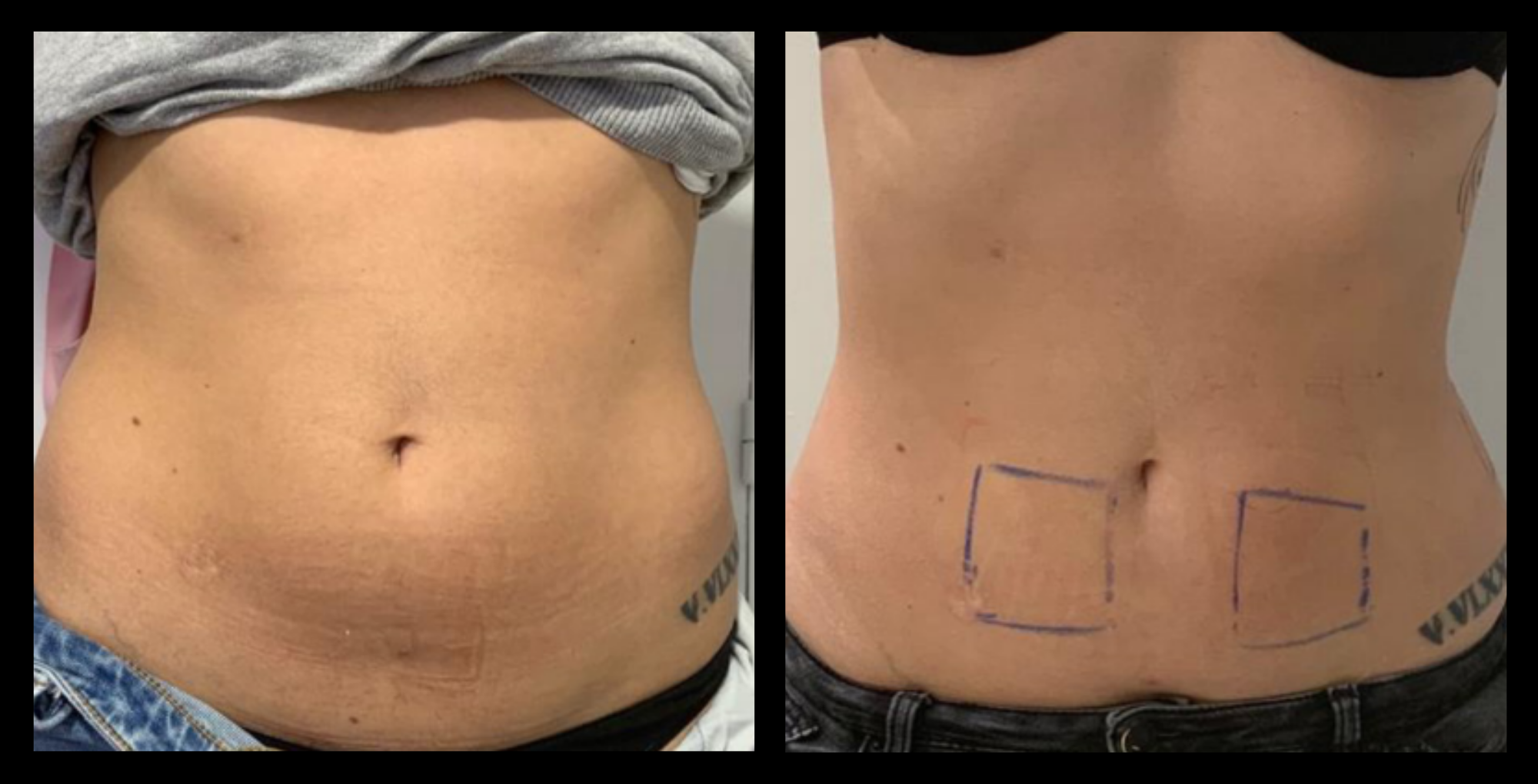 Before and after image of medical-grade fat reduction machine on abdomen after 2 treatments, showing noticeable slimming and improved abdominal contour. Photo courtesy of Lightfective.