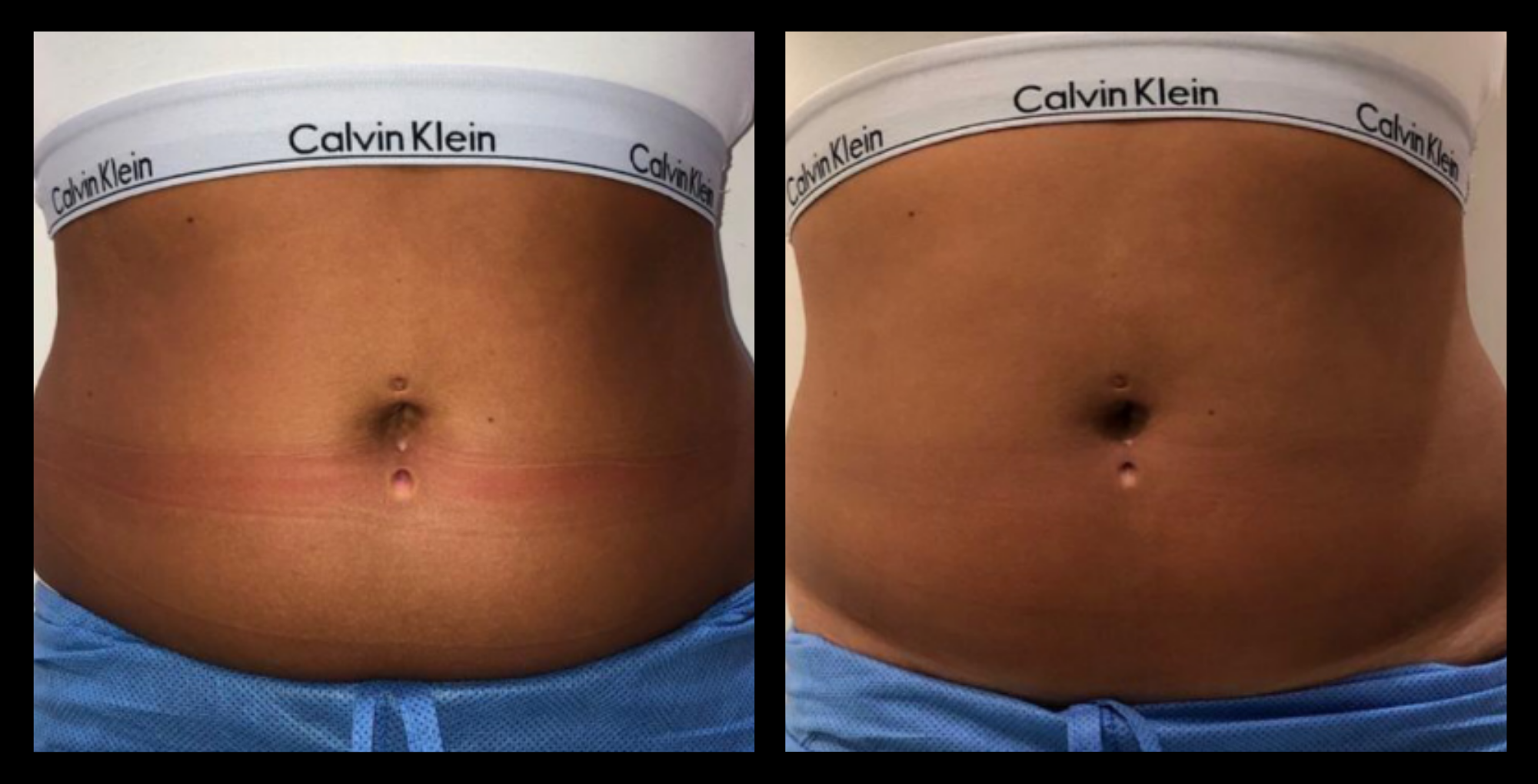 Before and after image of medical-grade fat reduction machine on abdomen after 2 treatments, showing noticeable slimming and improved abdominal contour. Photo courtesy of Lightfective.