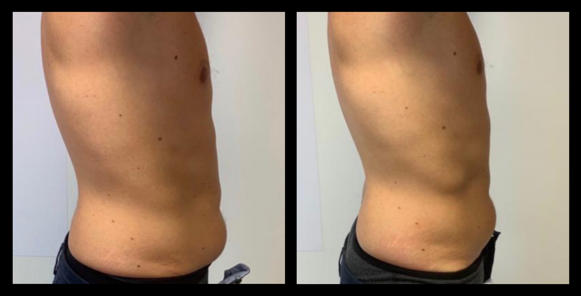 Before and after image of medical-grade fat reduction machine on abdomen after 2 treatments, showing noticeable slimming and improved abdominal contour. Photo courtesy of Lightfective.