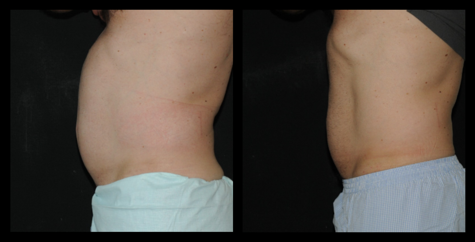 Before and after image of medical-grade fat reduction machine on abdomen after 2 treatments, showing noticeable slimming and improved abdominal contour. Photo courtesy of Lightfective.