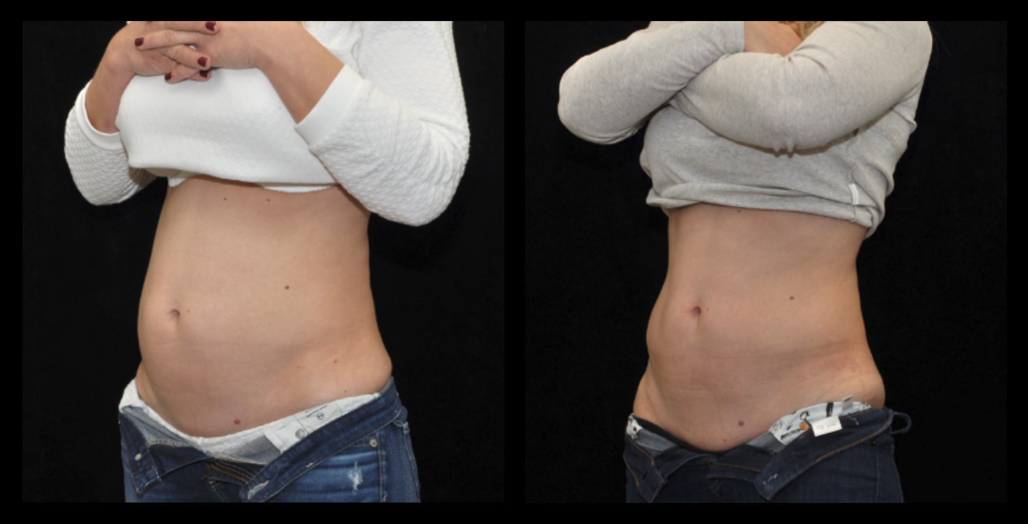 Before and after results showing visible abdominal fat reduction after one medical-grade fat reduction machine treatment. Enhanced body contouring and improved waistline appearance. Photo courtesy of Prof. Moshe Lapidot (IL).