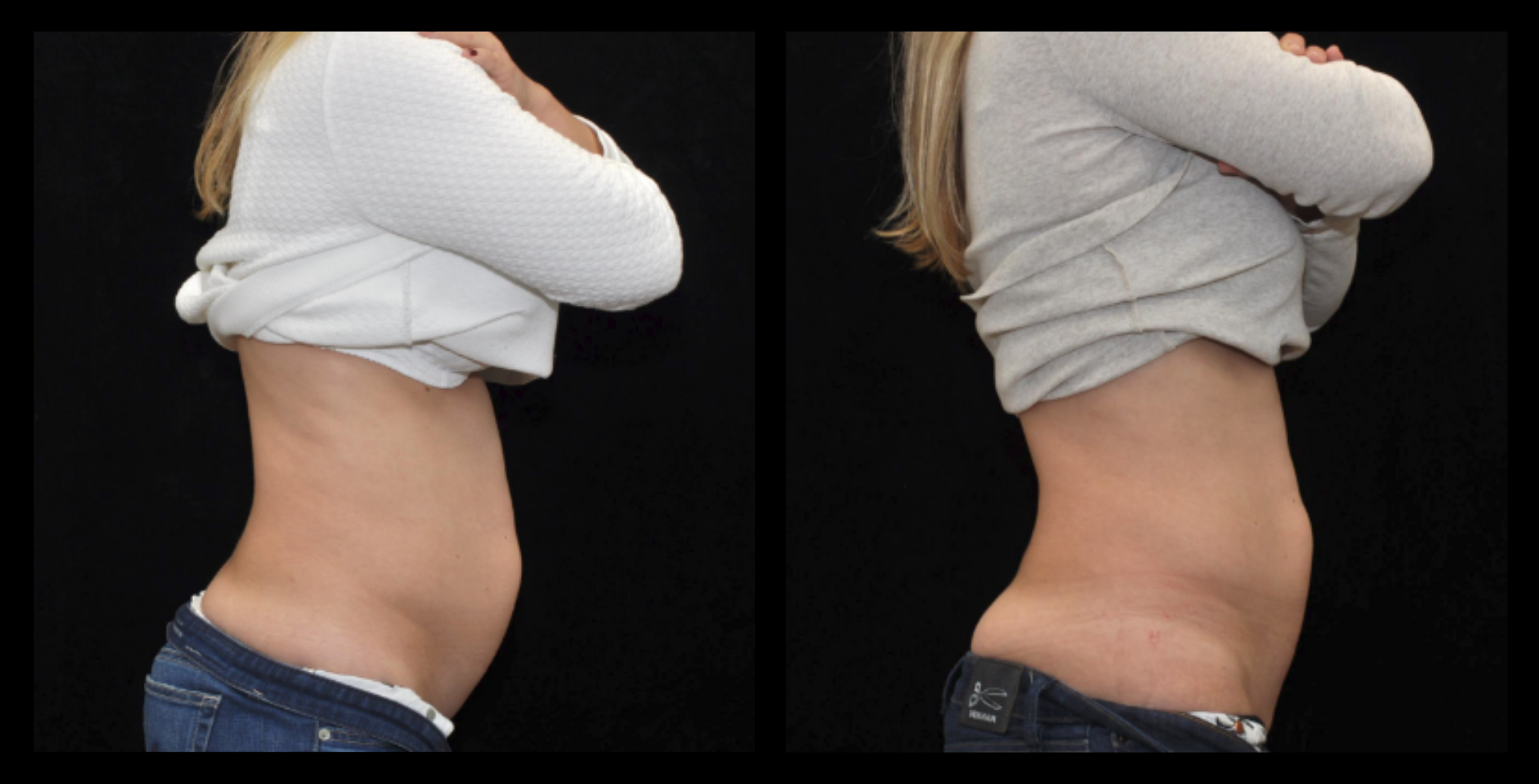 Before and after results showing visible abdominal fat reduction after one medical-grade fat reduction treatment. Enhanced body contouring and improved waistline appearance. Photo courtesy of Prof. Moshe Lapidot (IL).