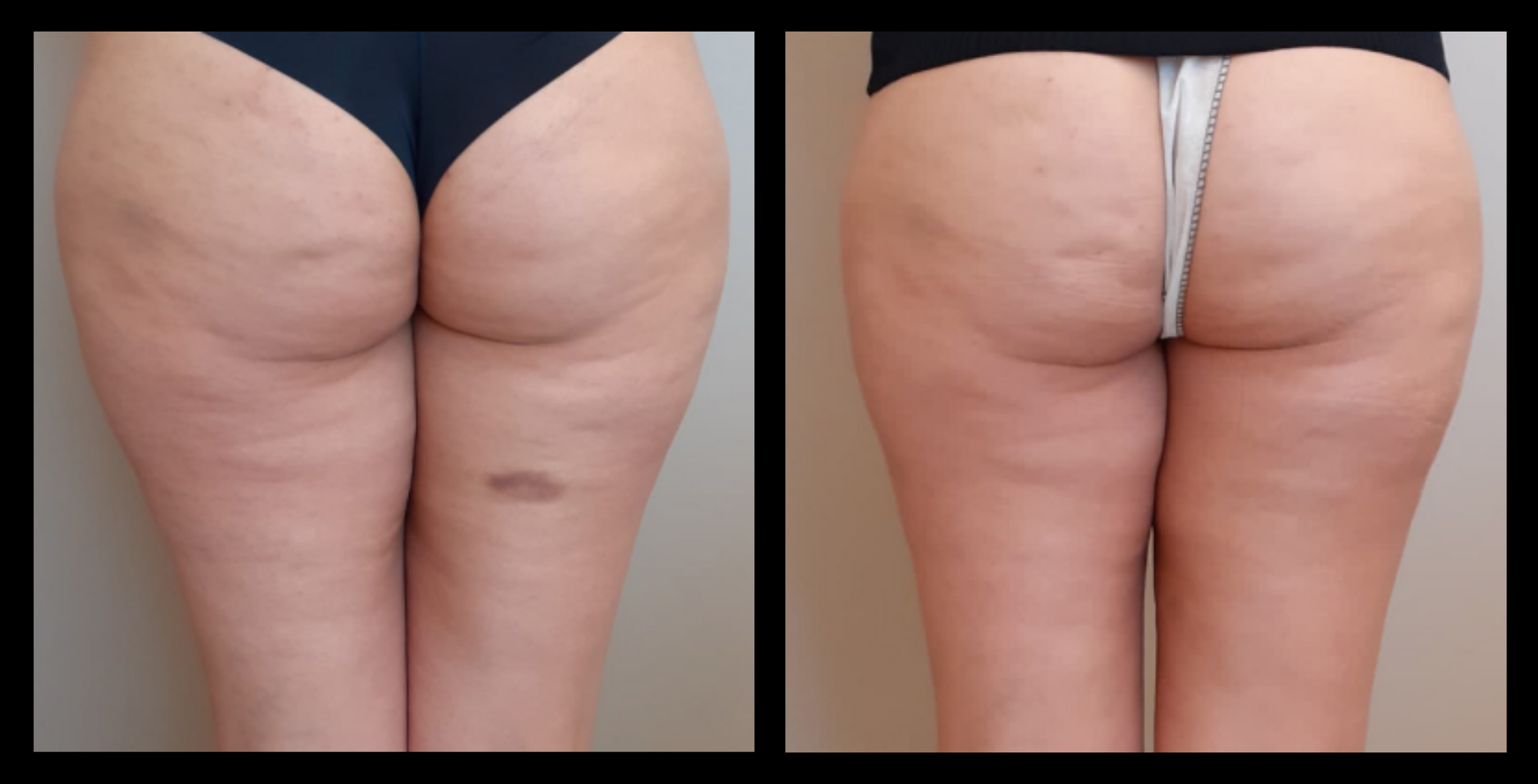 Before and after image highlighting visible fat reduction machine treatment and improved contour of the thighs following 3 medical-grade fat reduction treatments. Photo courtesy of Dr. Carlo Borriello (IT).