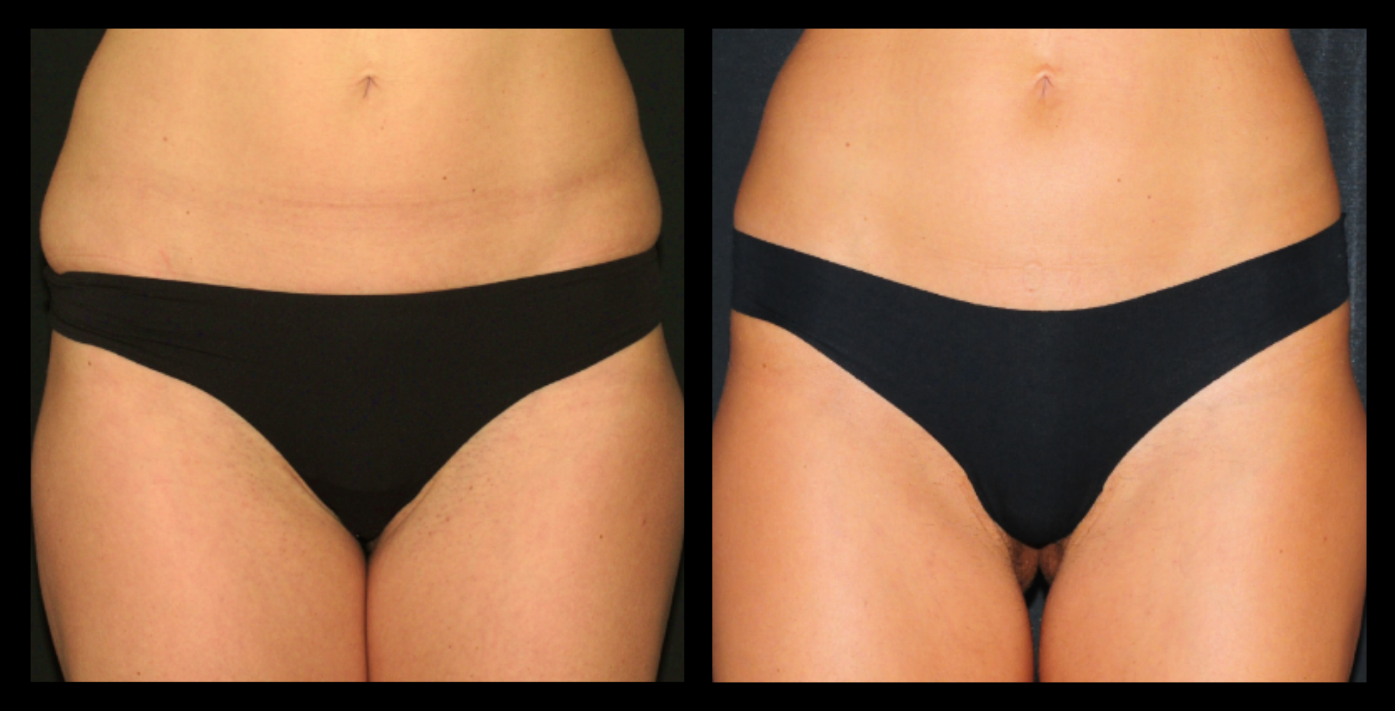 Before and after image showing significant reduction in abdominal fat after 3 medical-grade fat reduction machine treatment. Noticeable slimming and contouring of the midsection. Photo courtesy of Dr. Carlo Borriello (IT).
